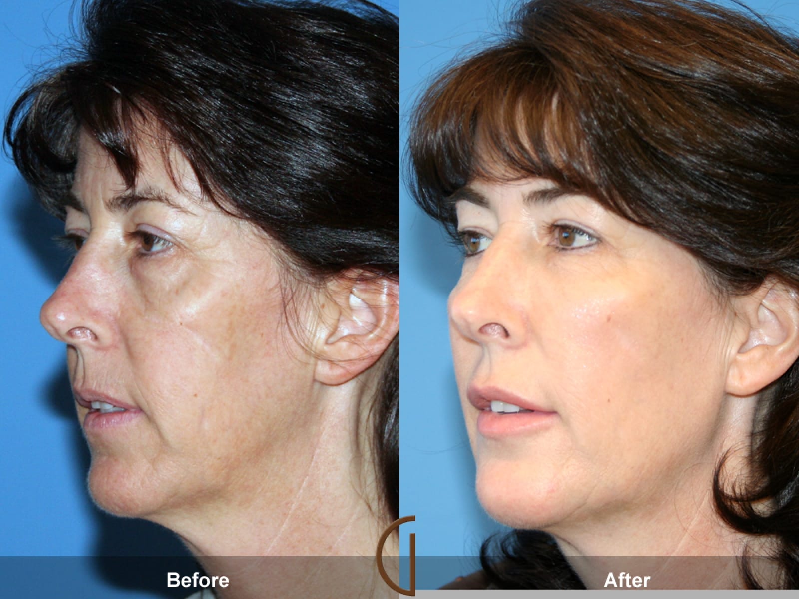 Facial Fat Grafting Orange County CA 21 Image