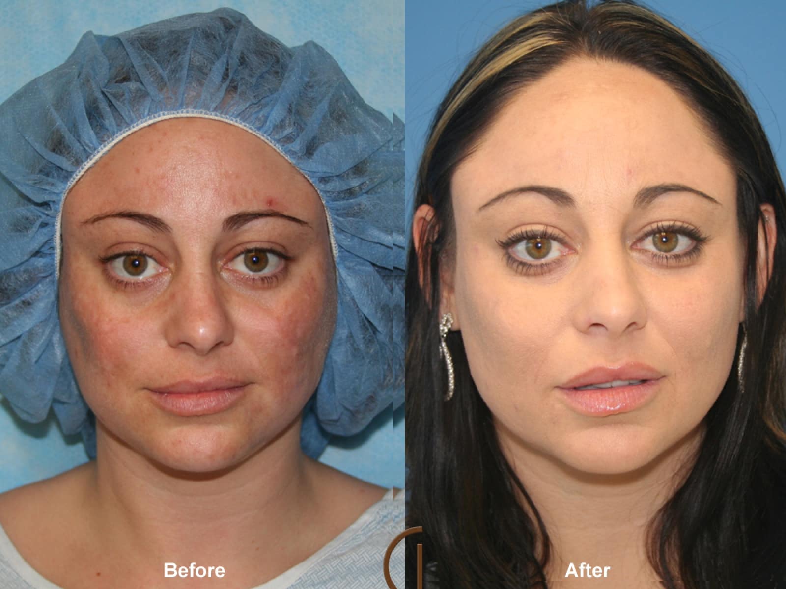 Facial Fat Grafting Yorba Linda CA 22 Image