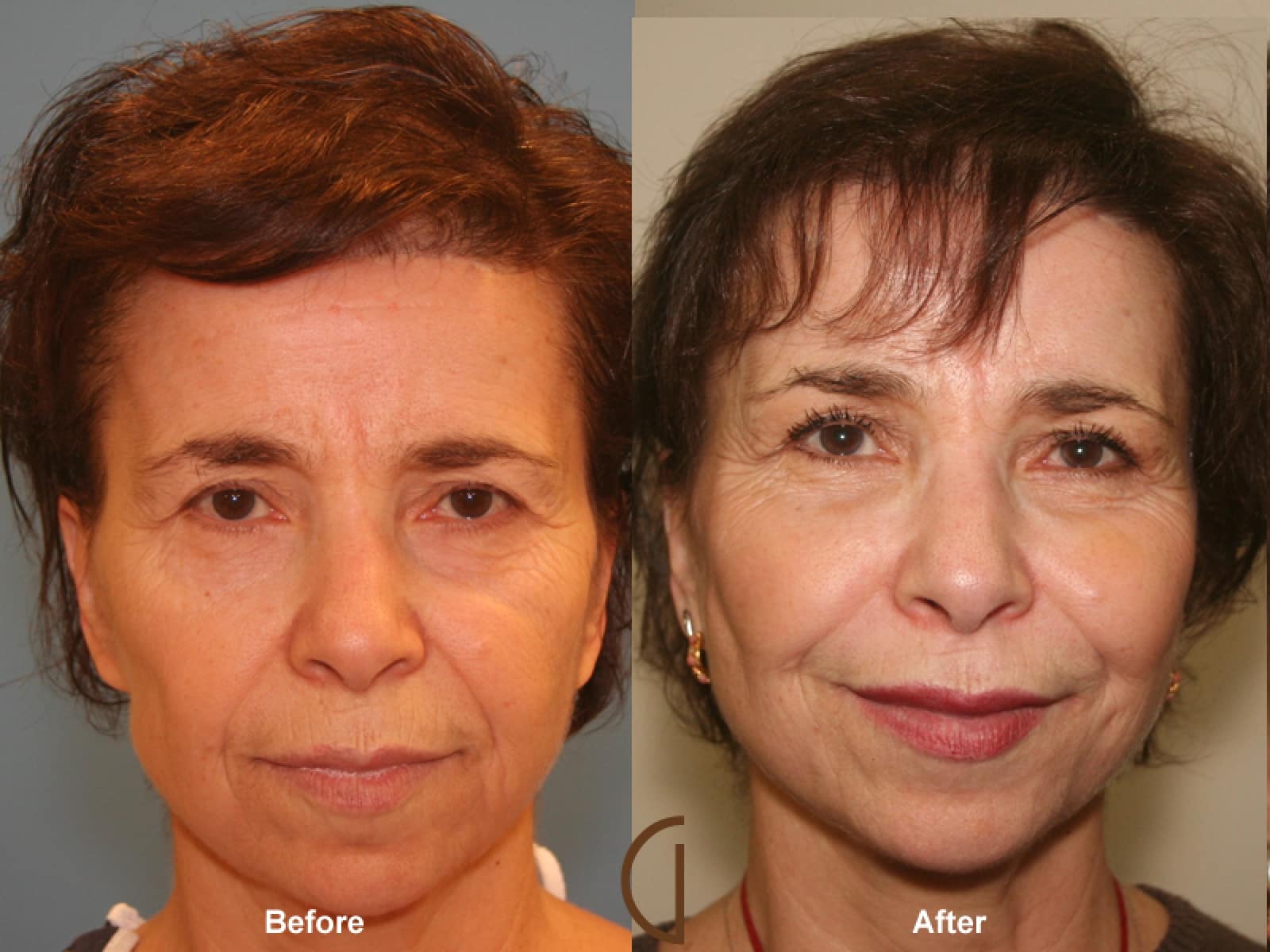 Facial Fat Grafting Rossmoor CA 23 Image