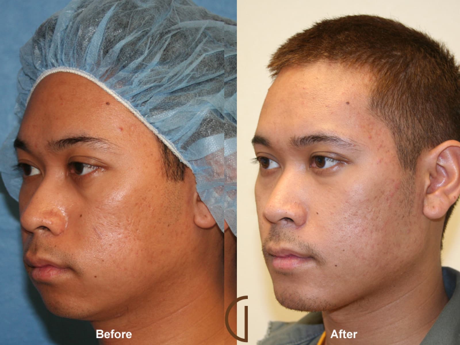 Facial Fat Grafting Newport Beach CA 24 Image