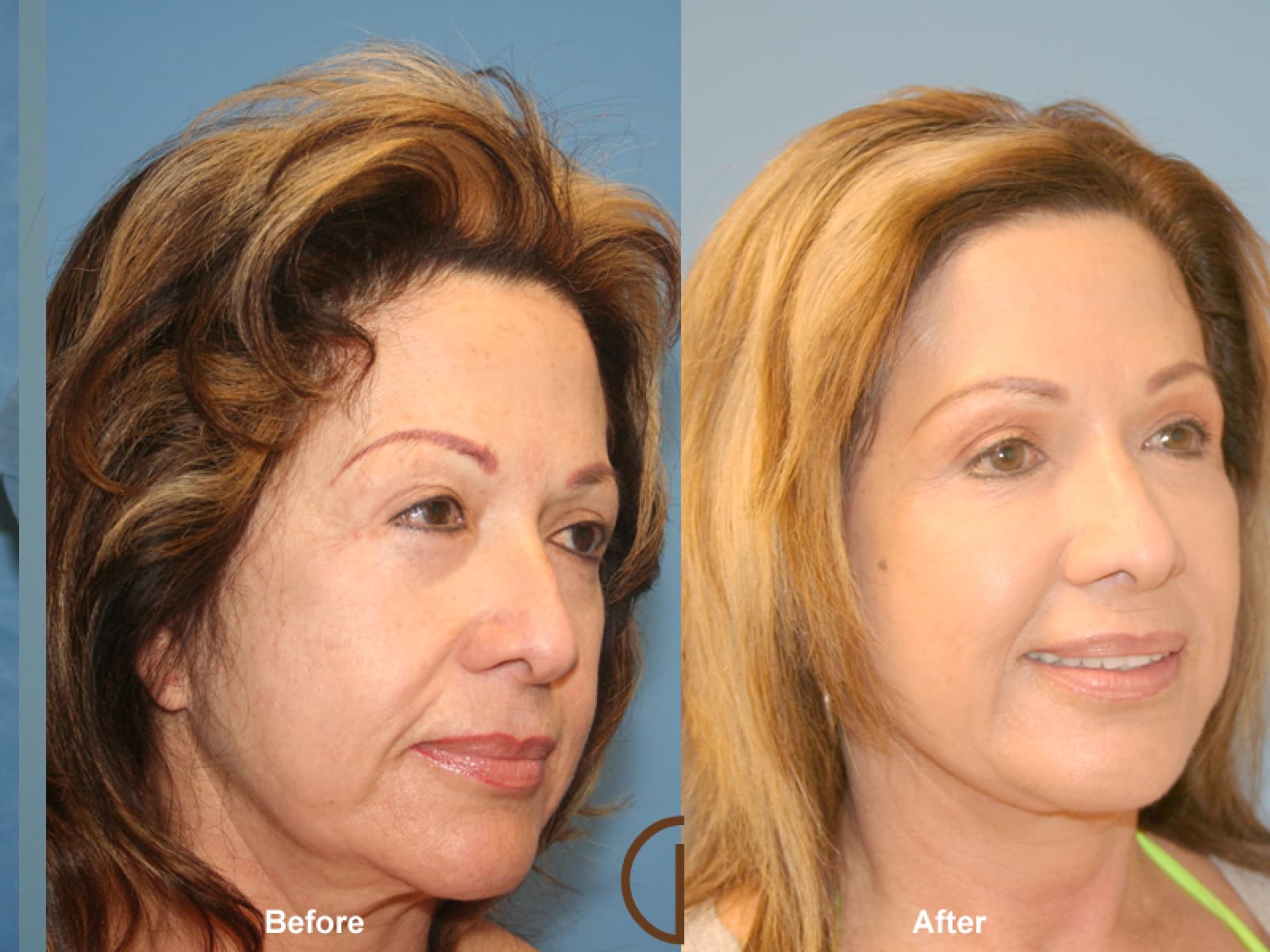 Facial Fat Grafting Rancho Santa Margarita CA 25 Image