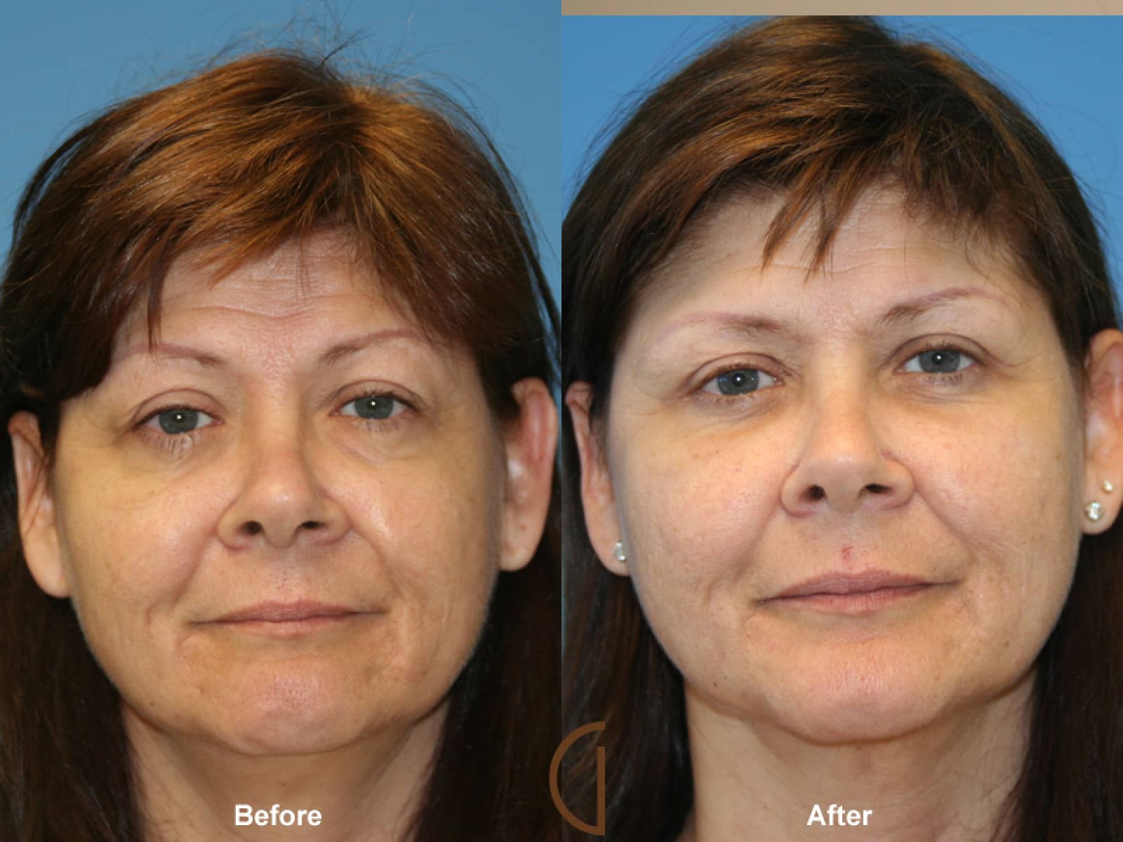 Facial Fat Grafting Aliso Viejo CA 26 Image