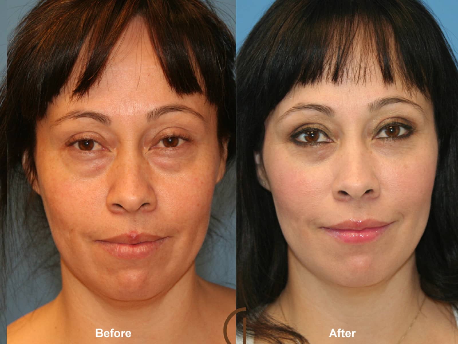 Facial Fat Grafting Los Alamitos CA 4 Image