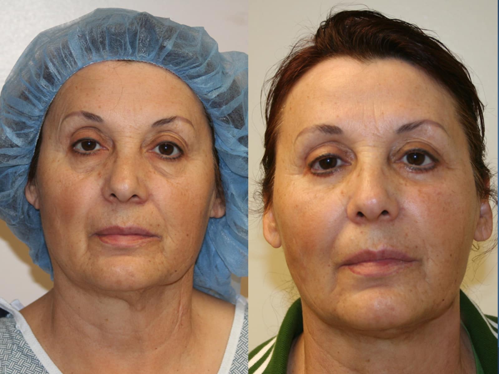 Facial Fat Grafting La Habra CA 5 Image