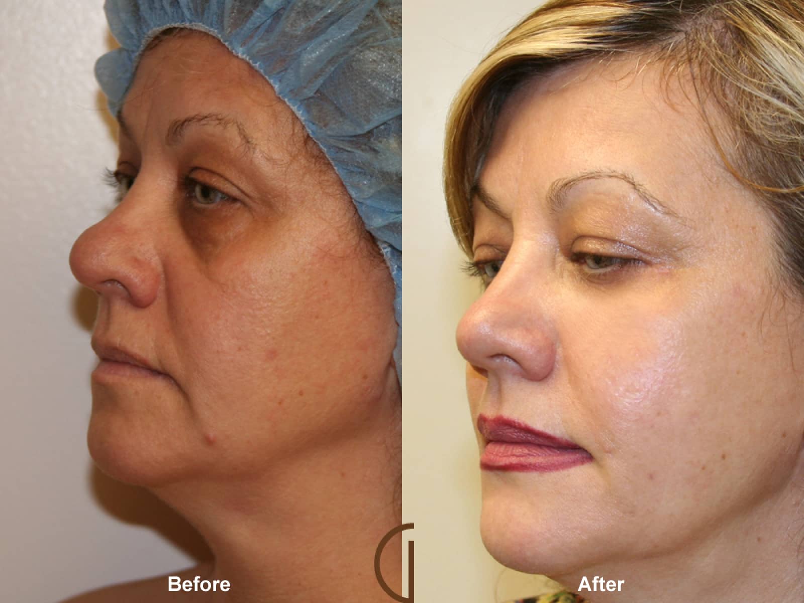 Facial Fat Grafting Orange County CA 8 Image