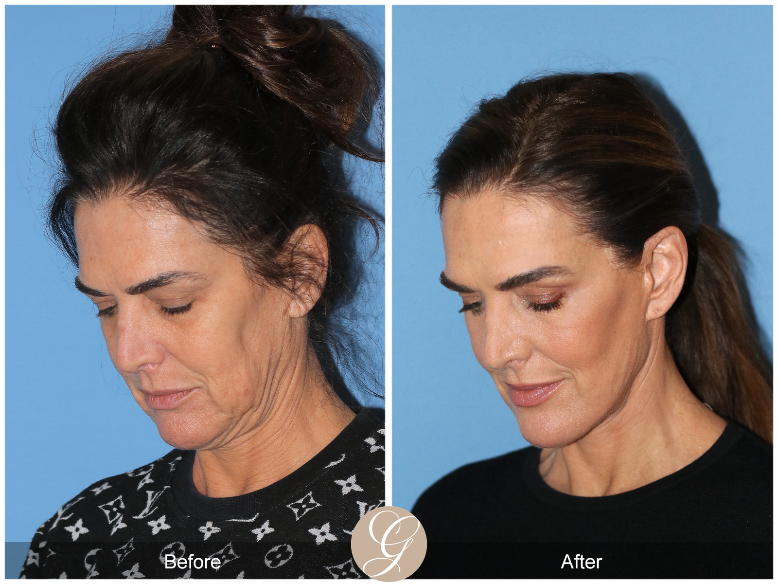 Preservation Facelift Case 1 Image