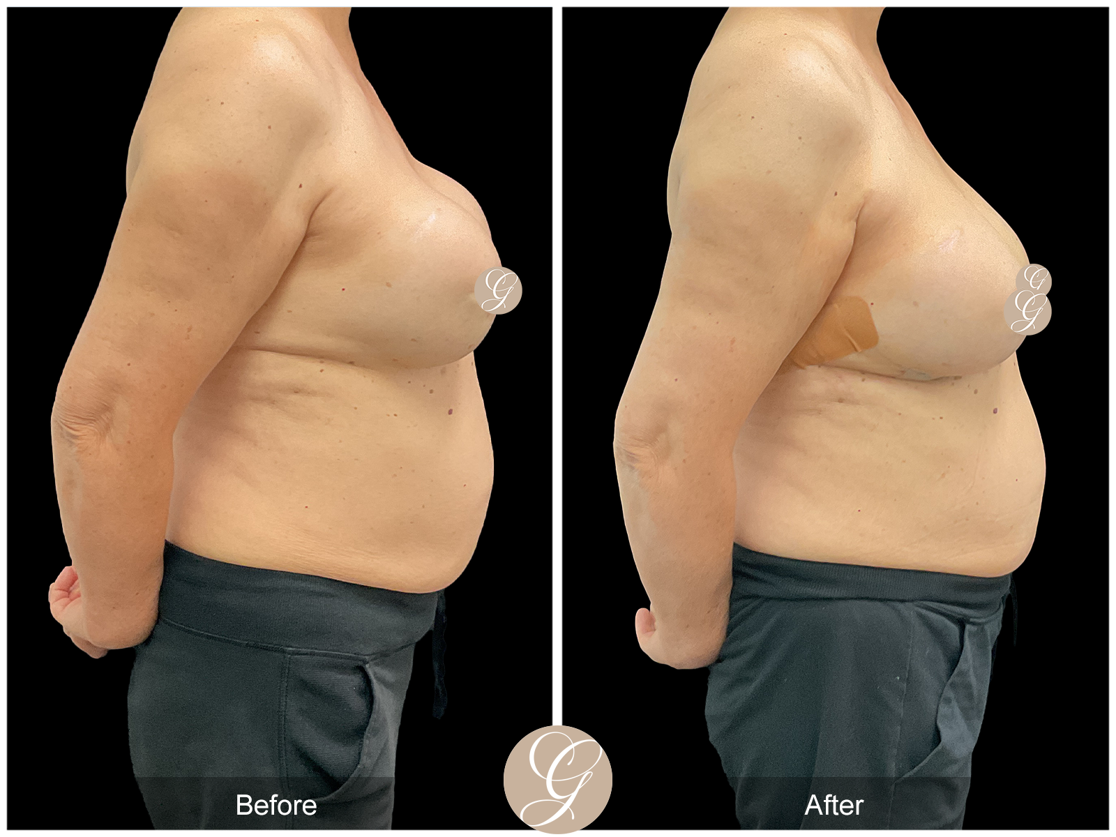 Breast Implant Revision 1 Image