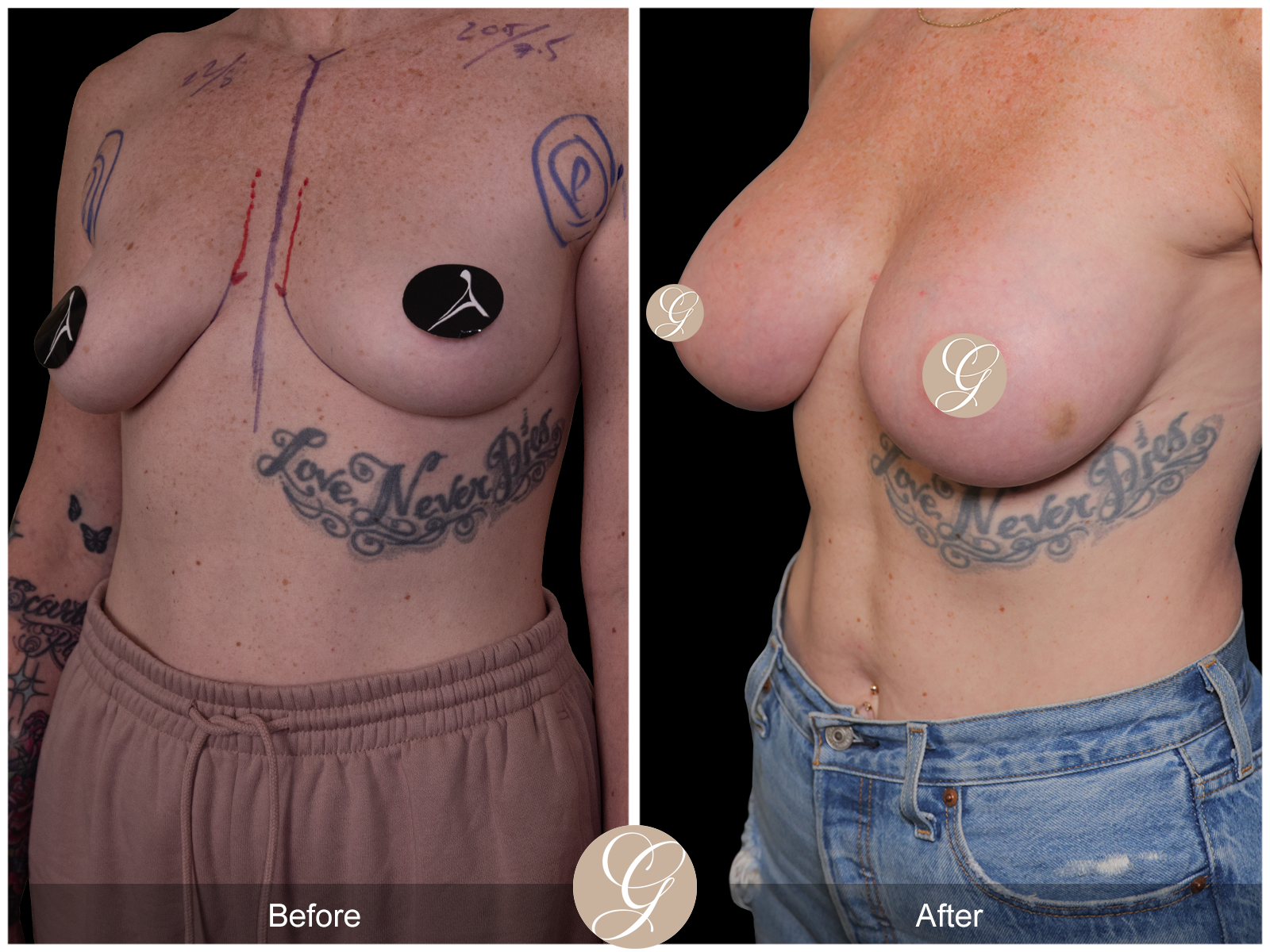 Breast Augmentation Image