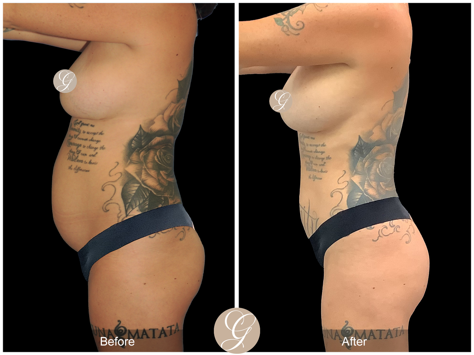 VASER 360 HIGH DEFINITION BODY SCULPTING PT14 Image