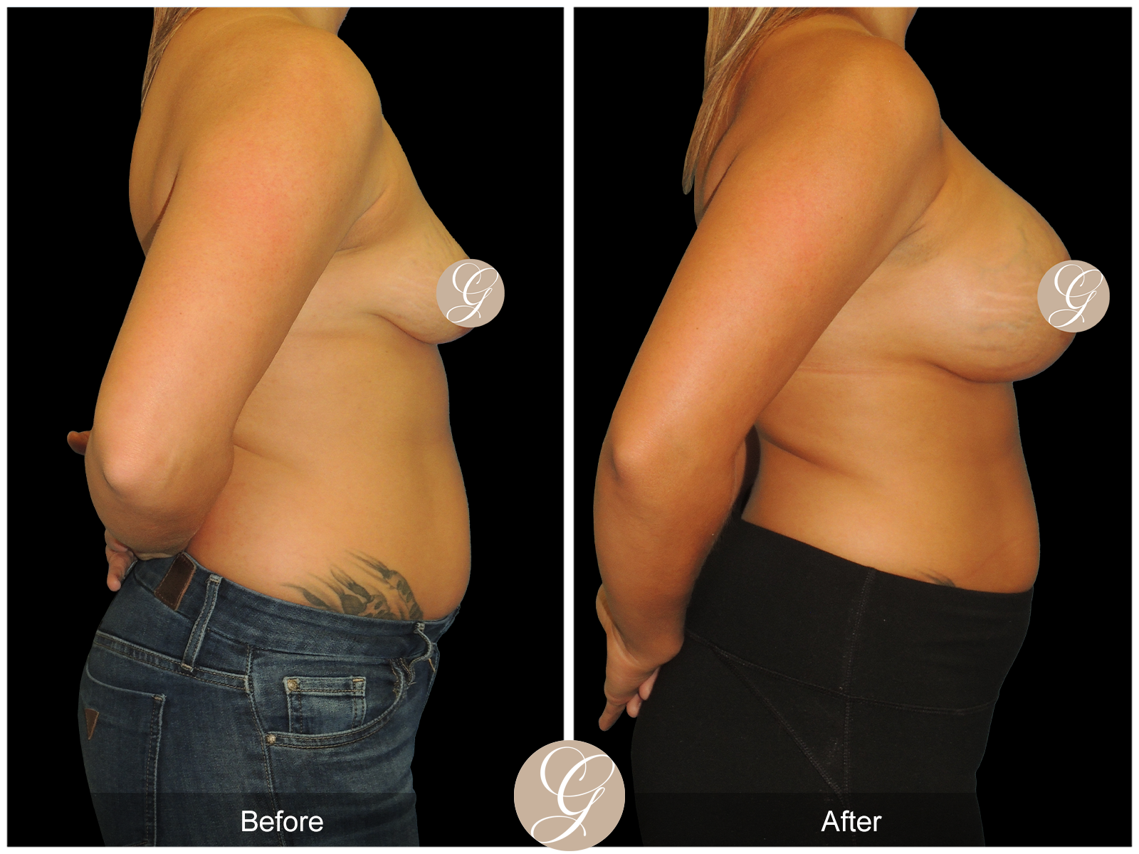 Breast Augmentation PT19 Image