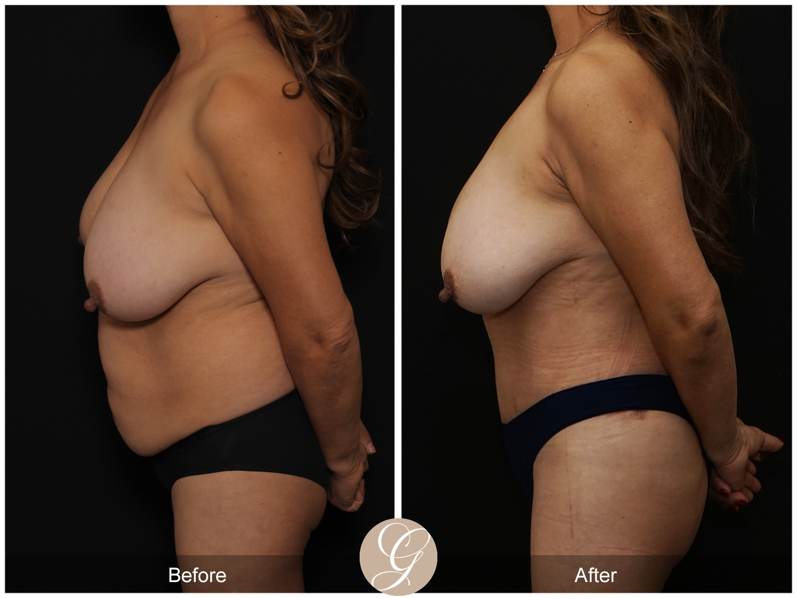 Tummy Tuck Pt 4 Image