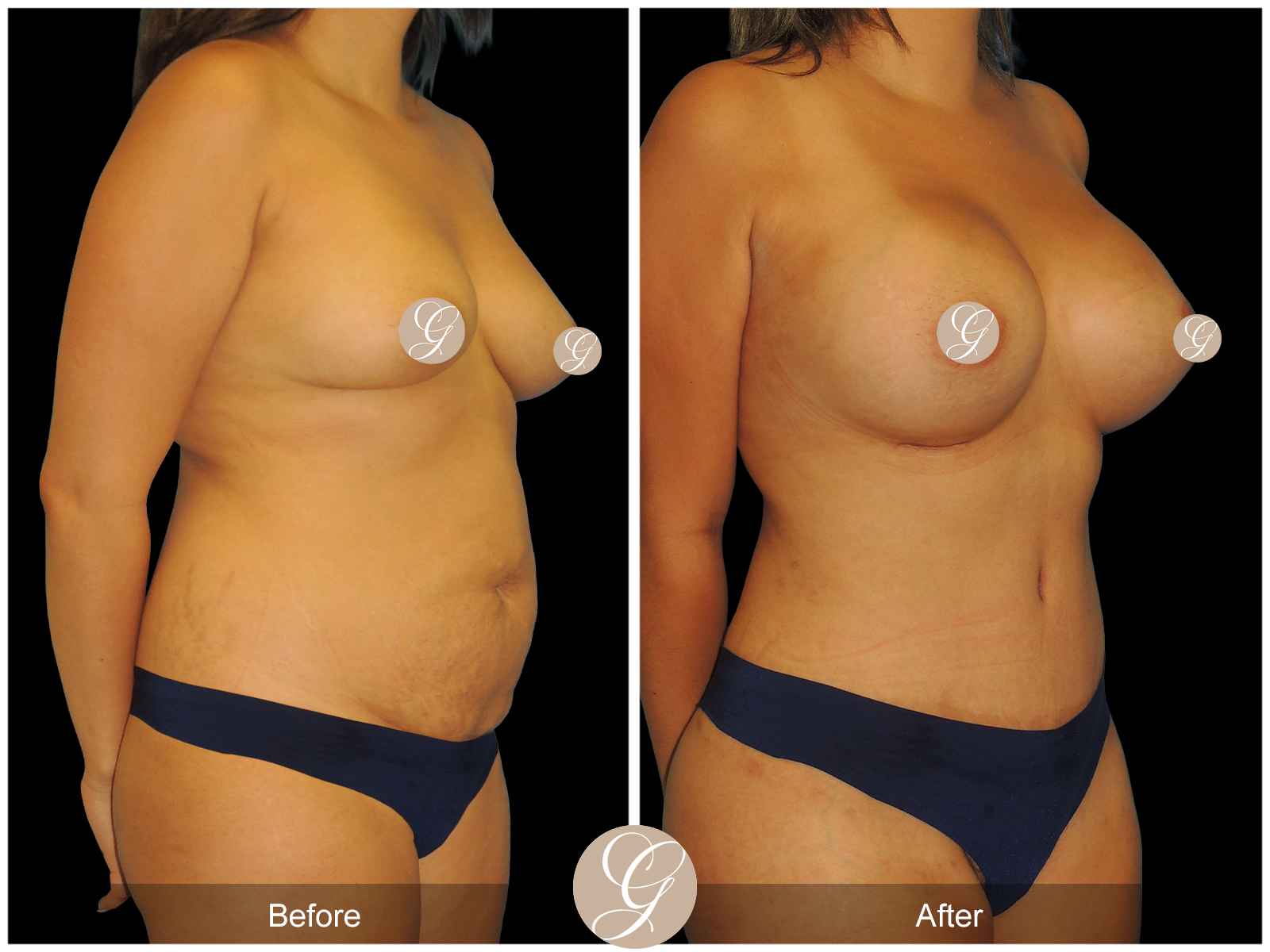 Tummy Tuck PT3 Image