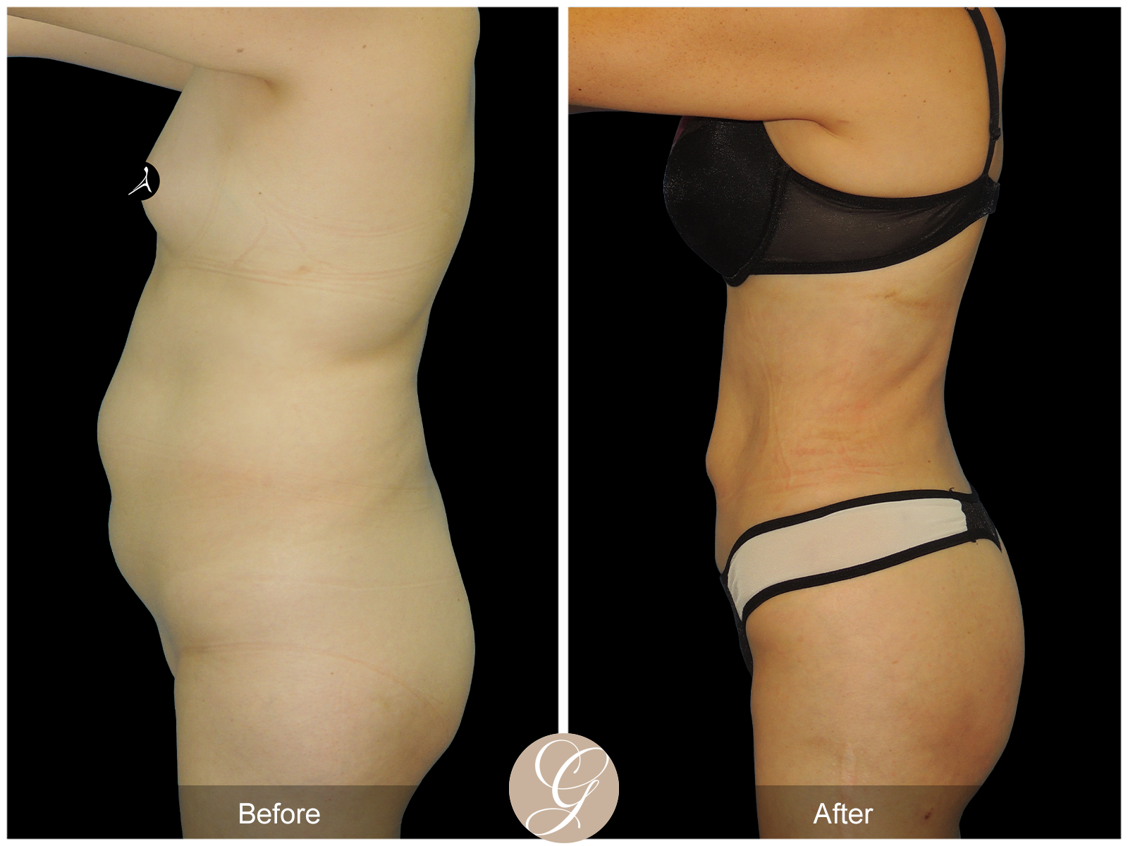 Liposuction PT3 Image