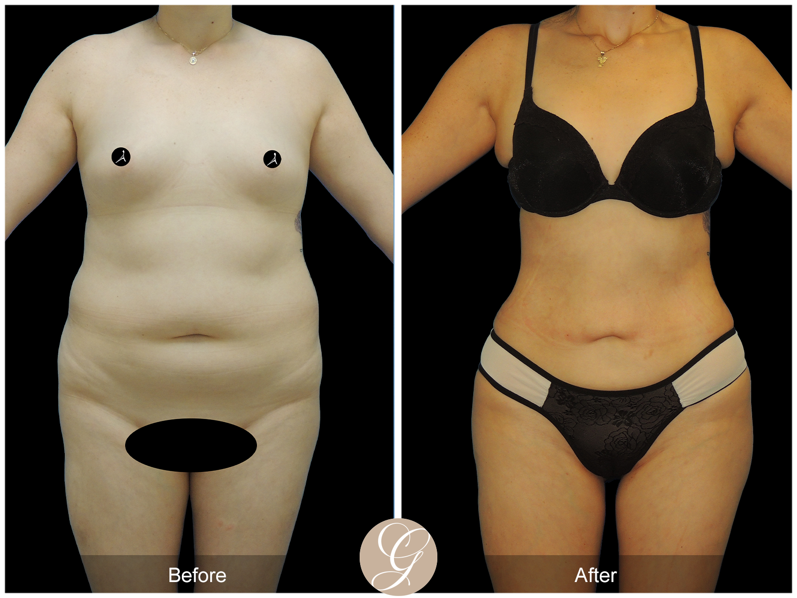 Liposuction PT3 Image