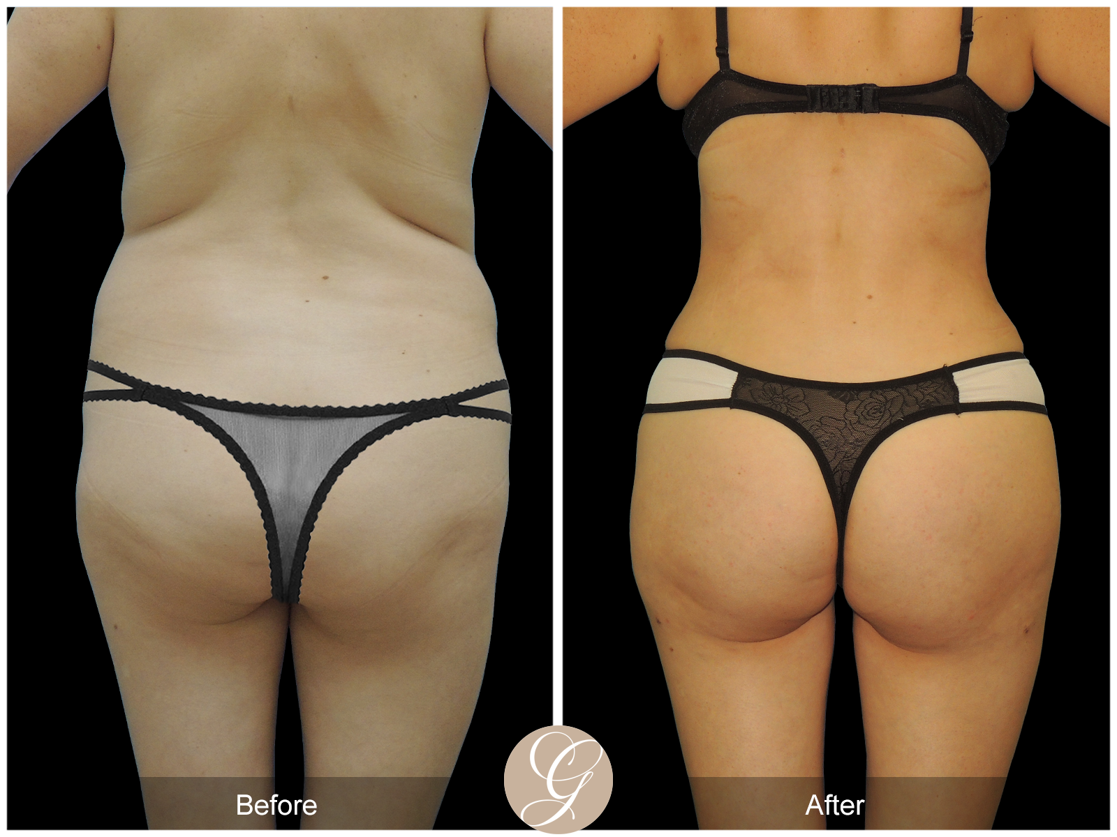 Liposuction PT3 Image
