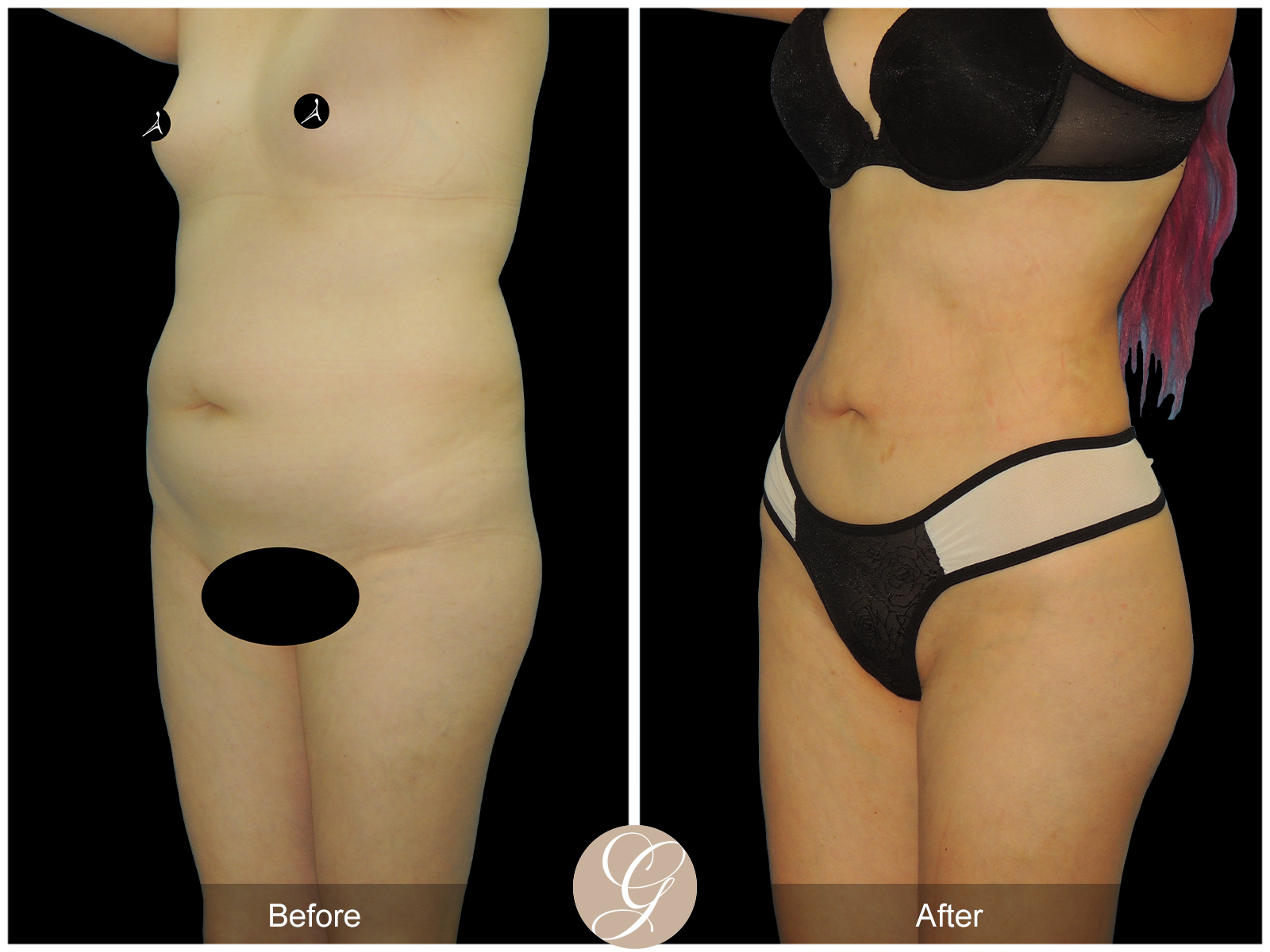 Liposuction PT3 Image