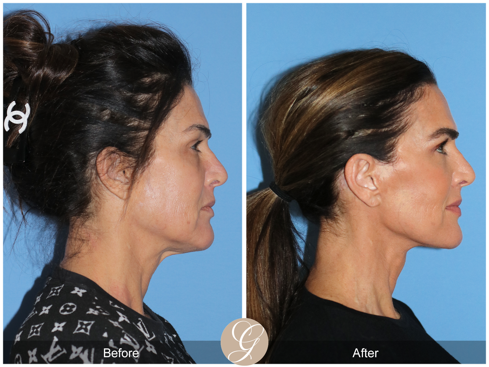 Preservation Facelift Case 1 Image