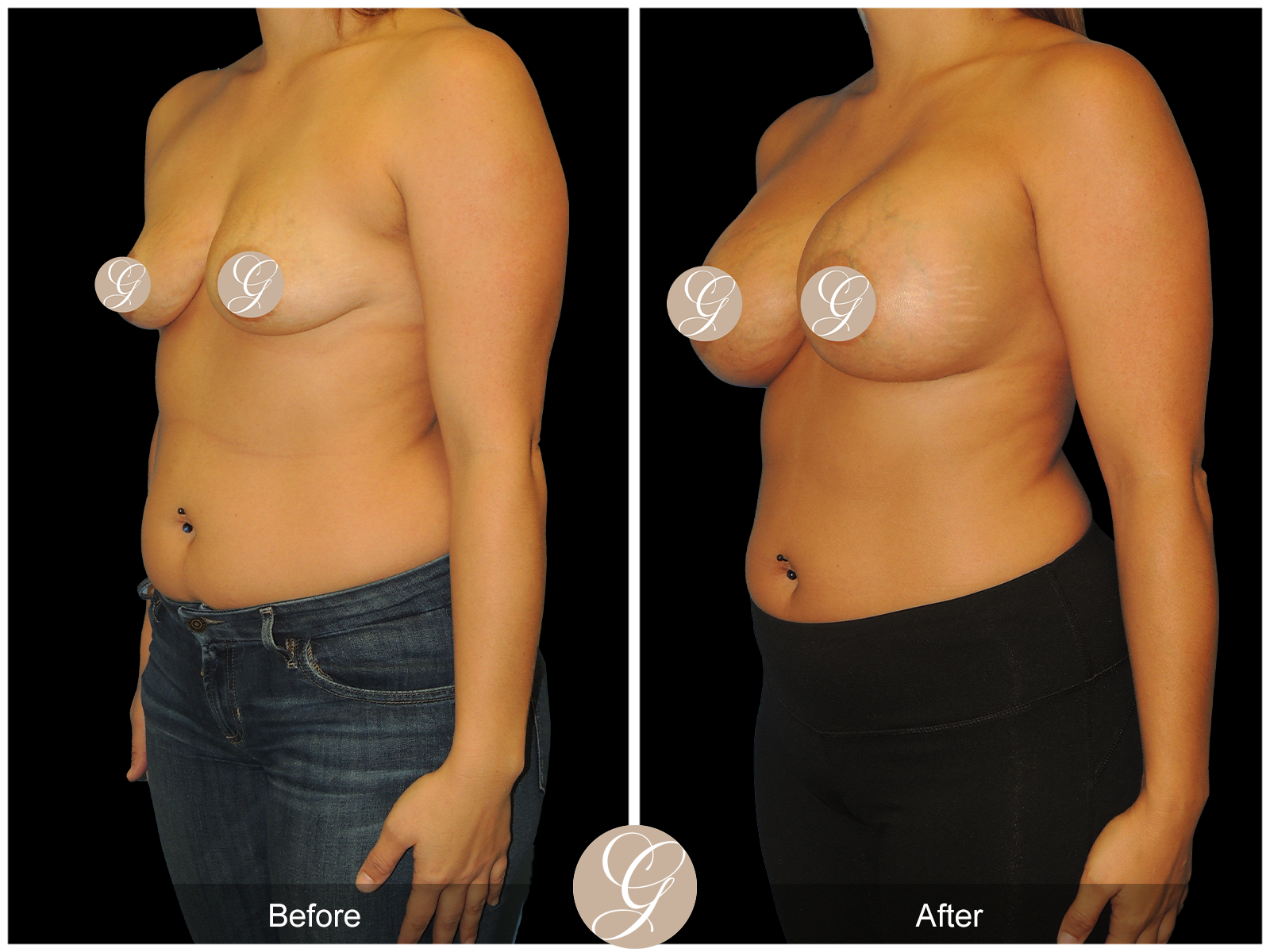 Breast Augmentation PT19 Image