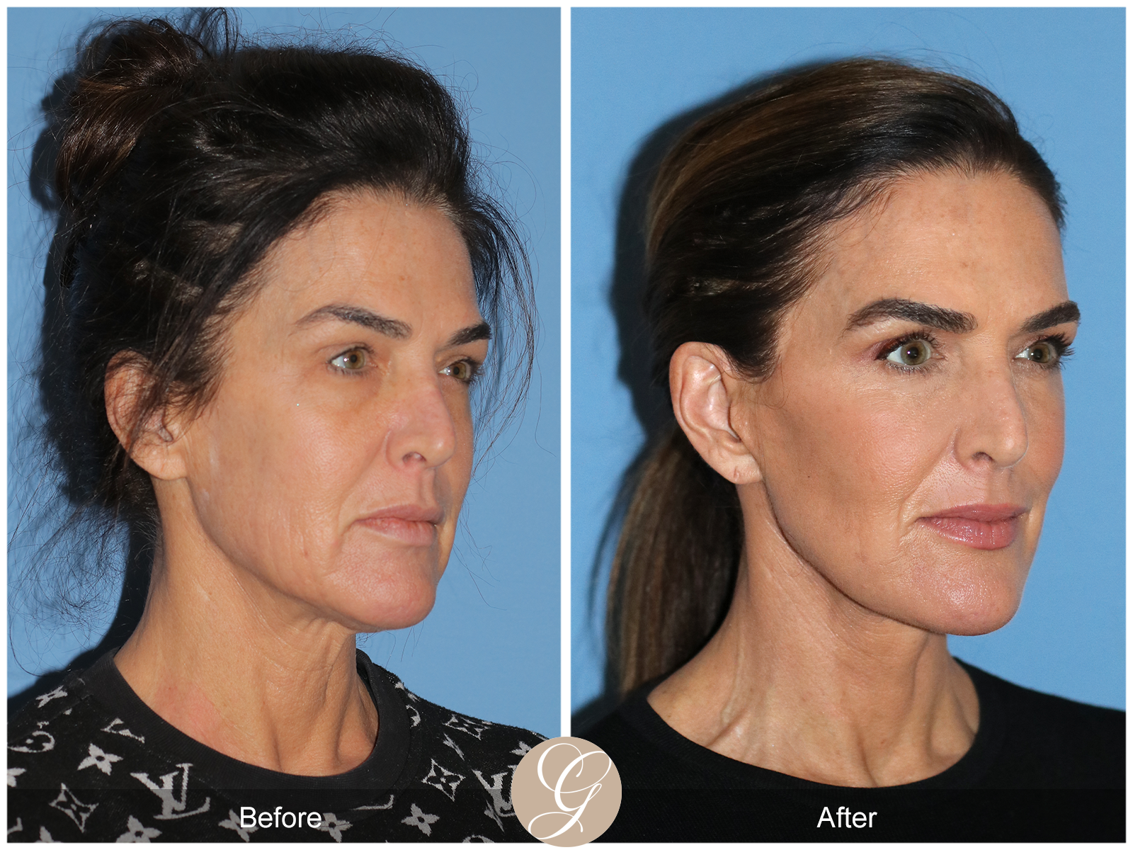 Preservation Facelift Case 1 Image