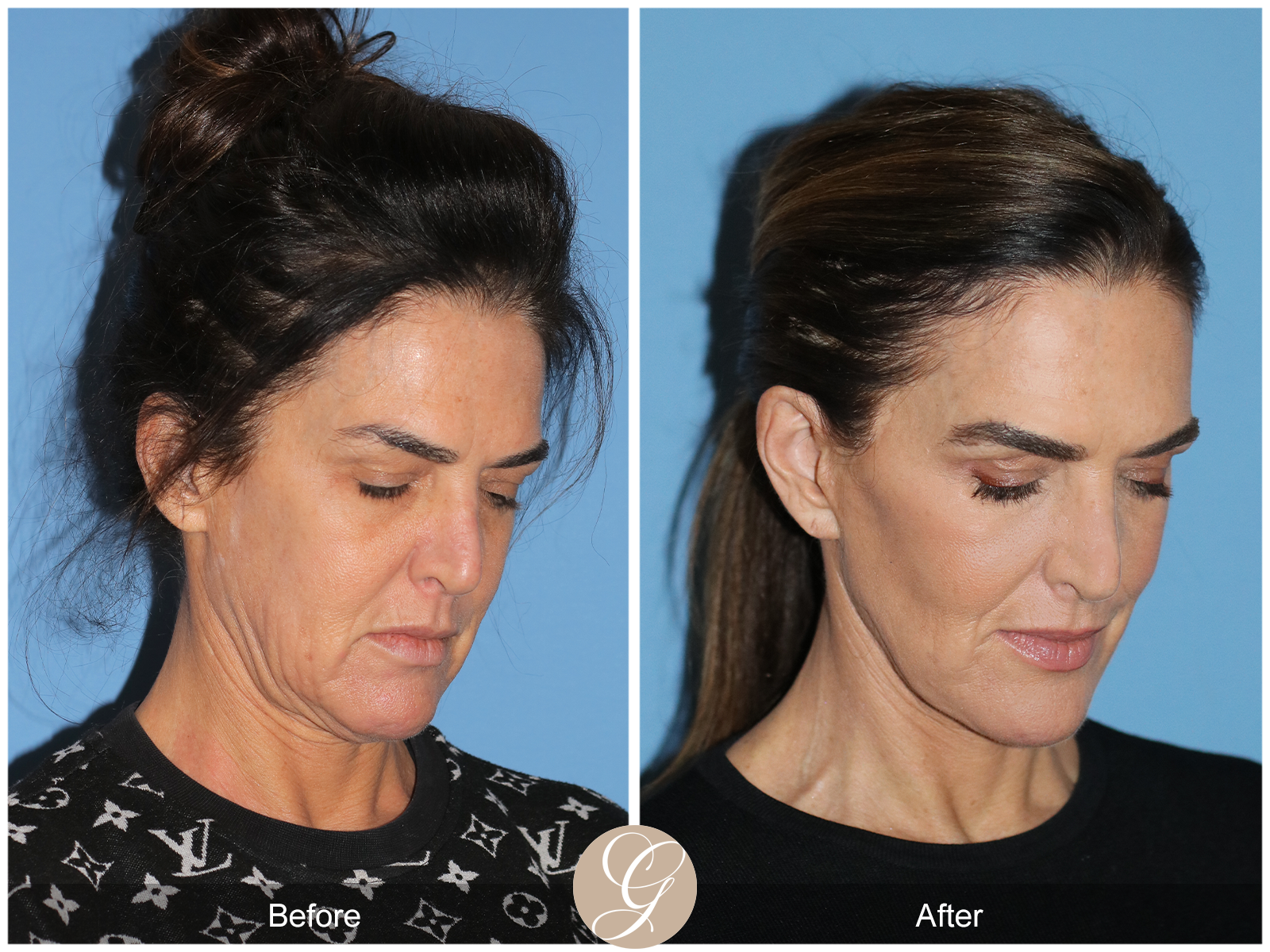 Preservation Facelift Case 1 Image