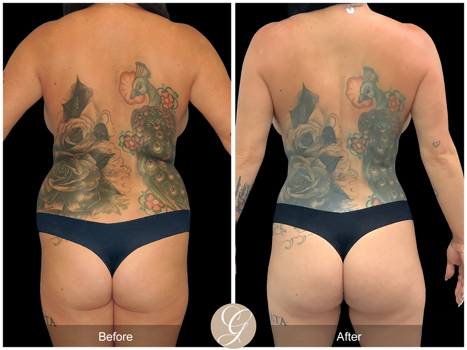 VASER 360 HIGH DEFINITION BODY SCULPTING PT14 Image