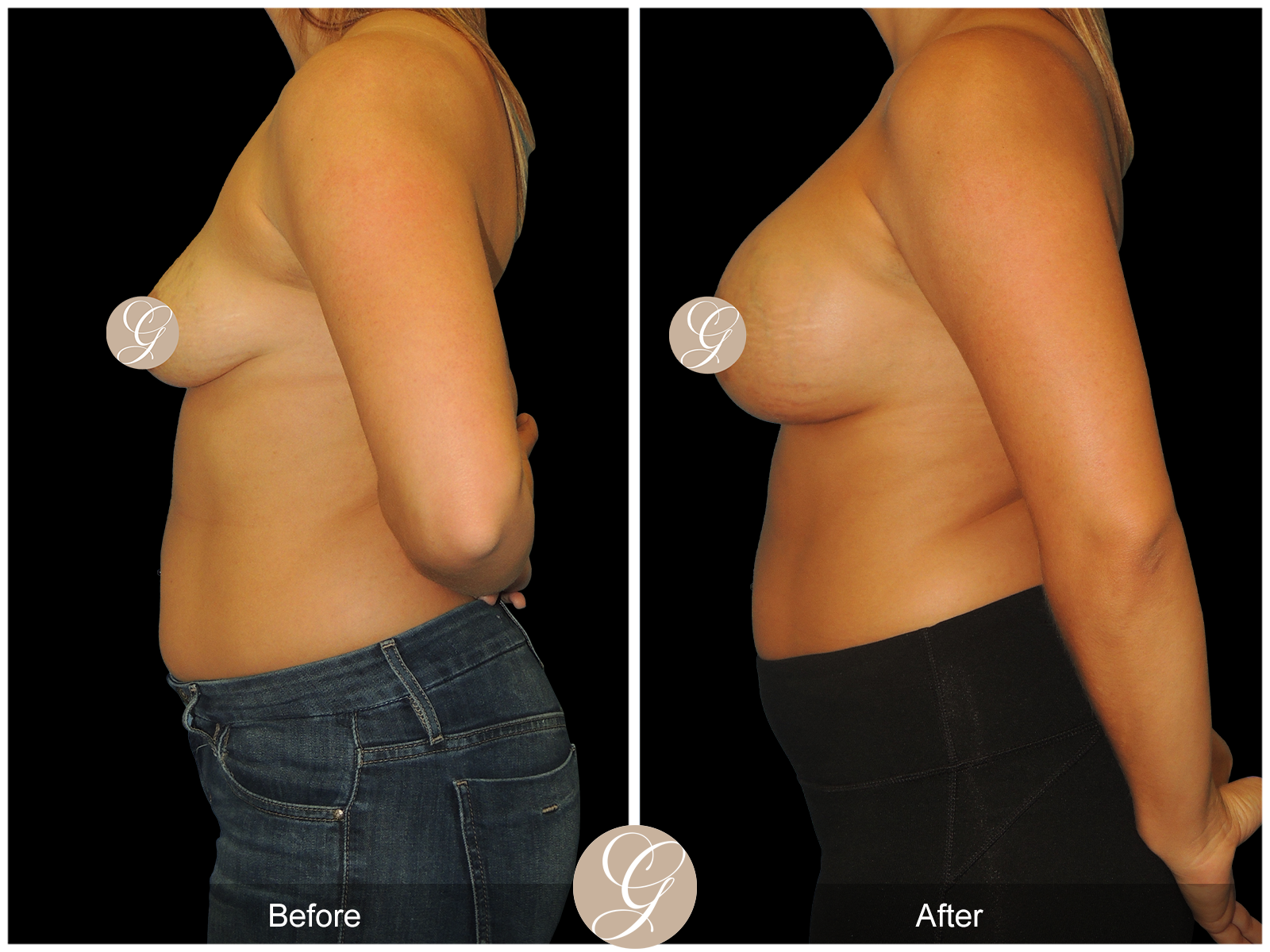 Breast Augmentation PT19 Image