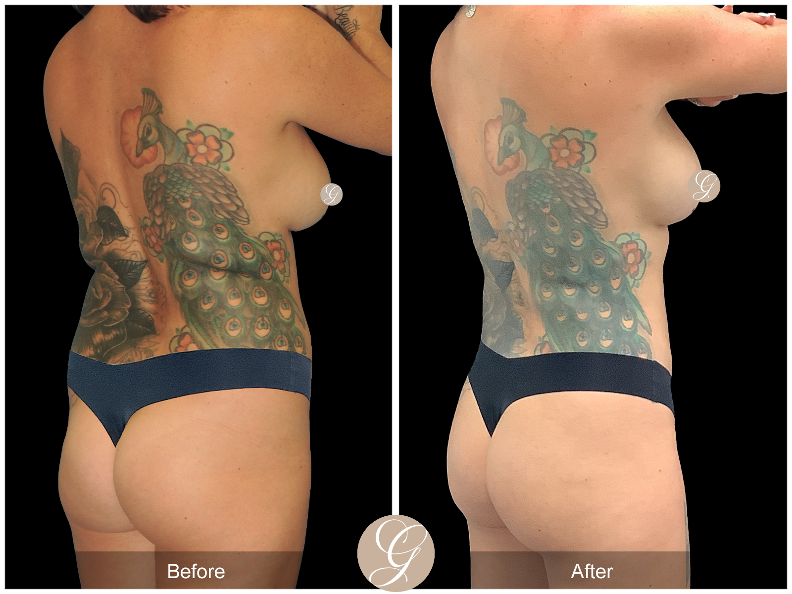 VASER 360 HIGH DEFINITION BODY SCULPTING PT14 Image