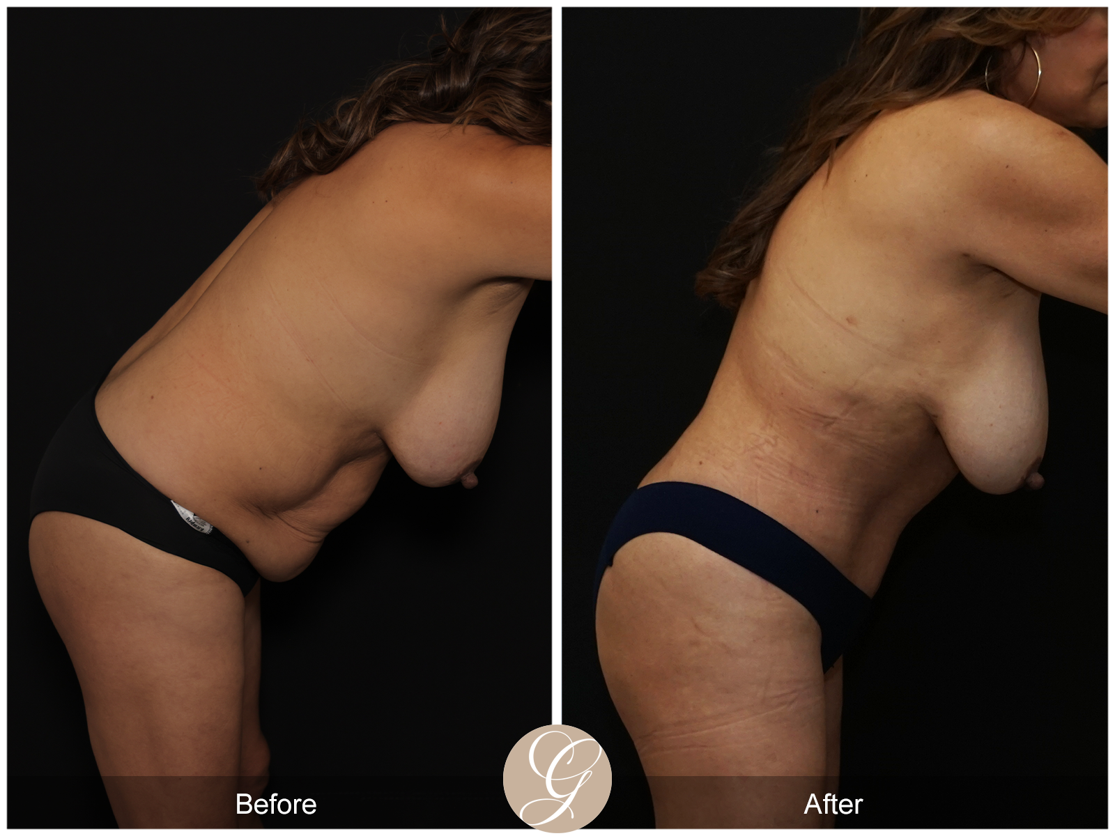 Tummy Tuck Pt 4 Image