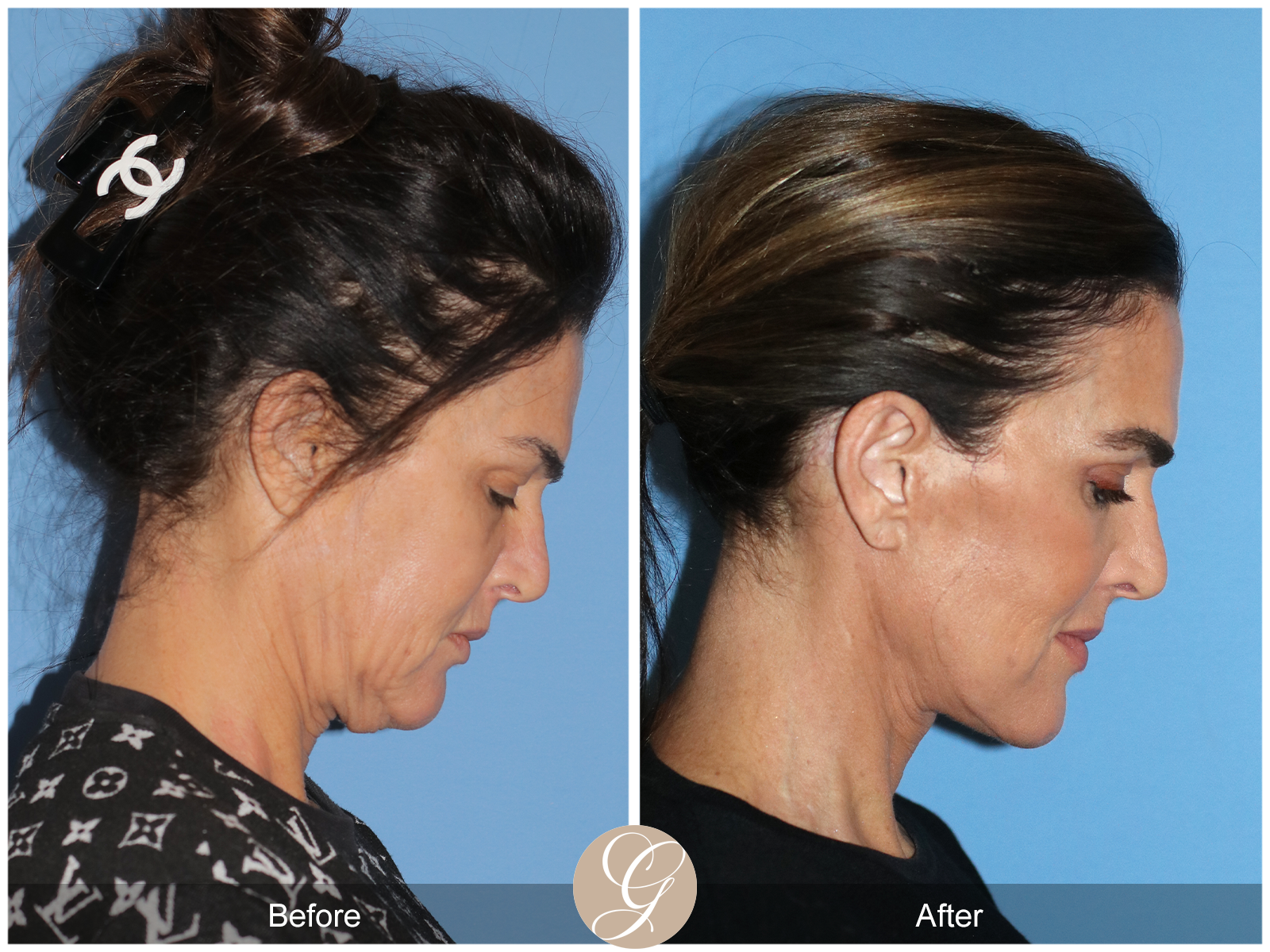 Preservation Facelift Case 1 Image