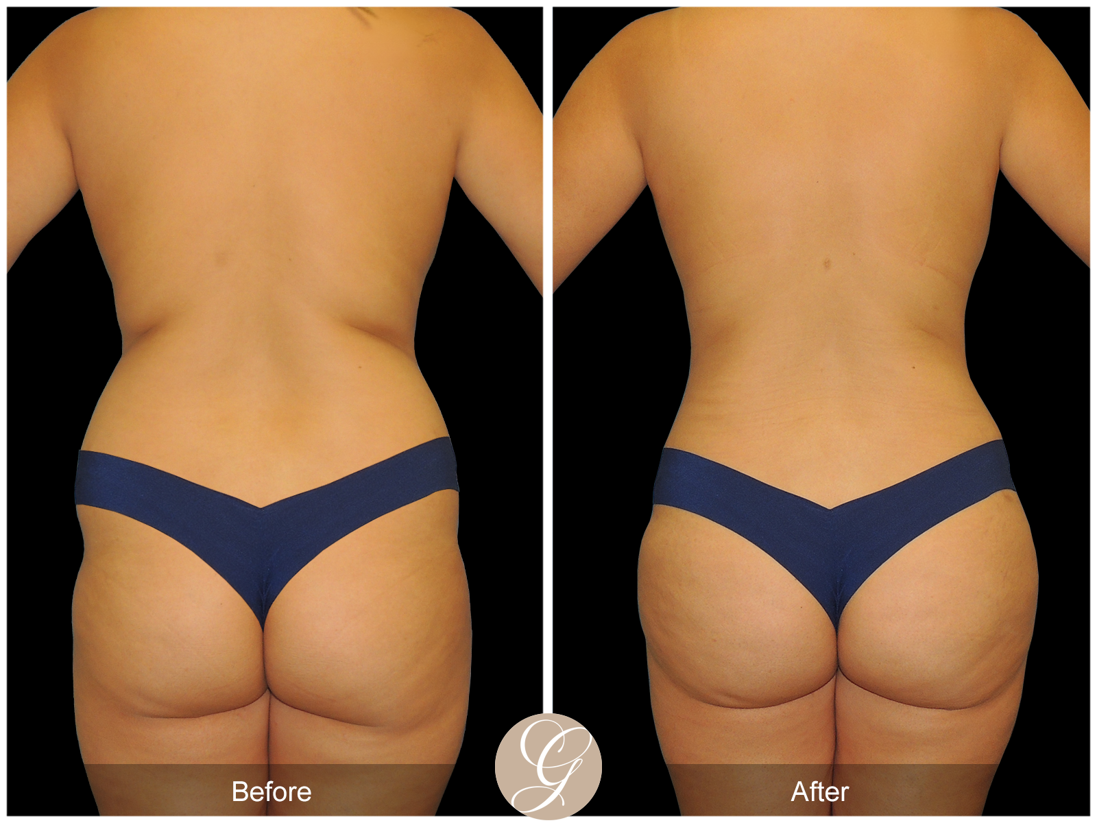 Tummy Tuck PT3 Image