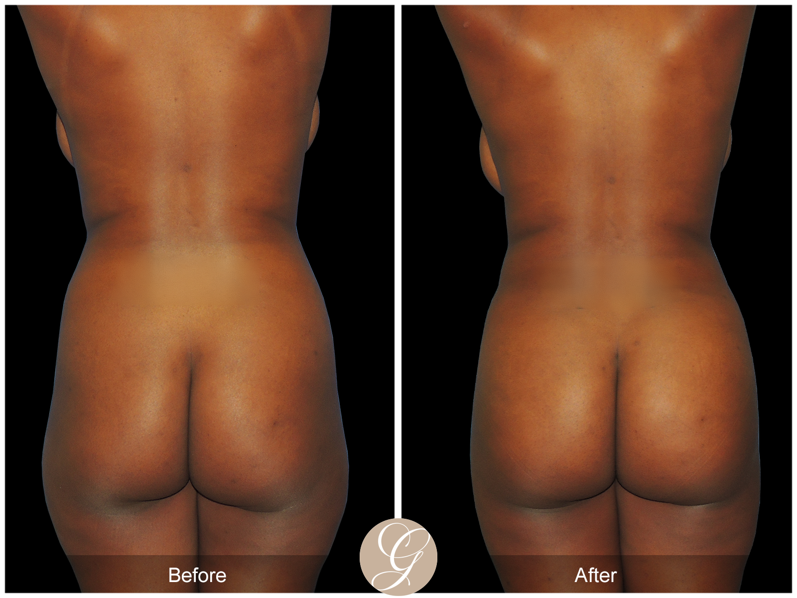 Brazillian Buttock Lift PT1 Image