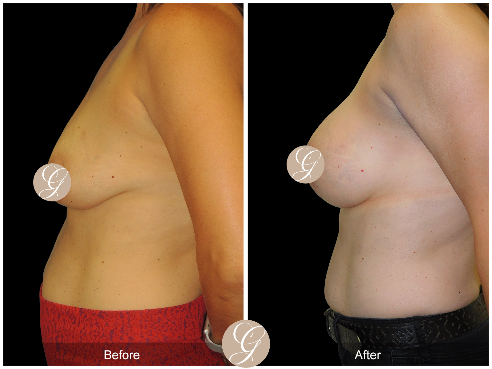 Breast Augmentation Lift with Mesh Image