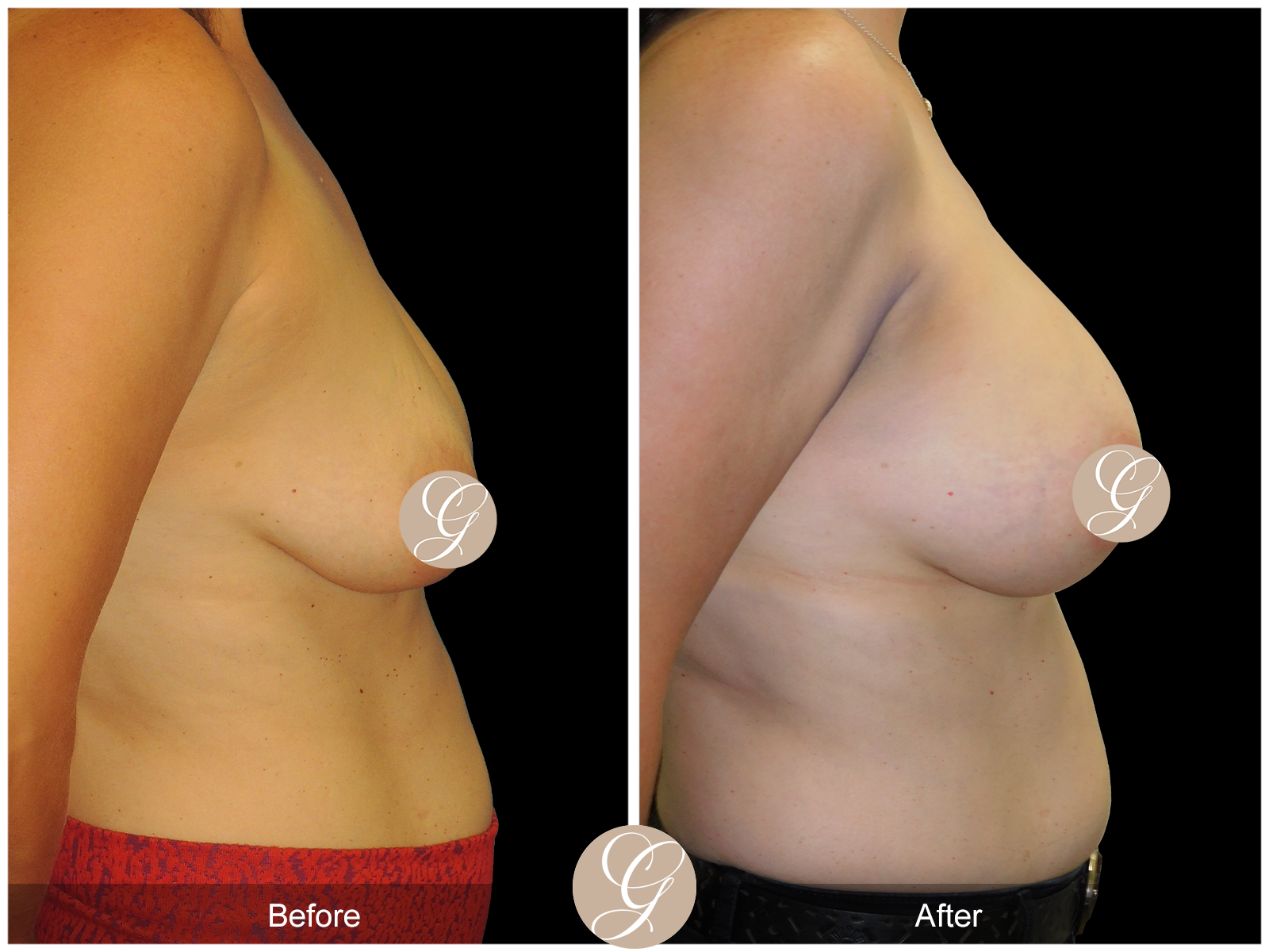 Breast Augmentation Lift with Mesh Image