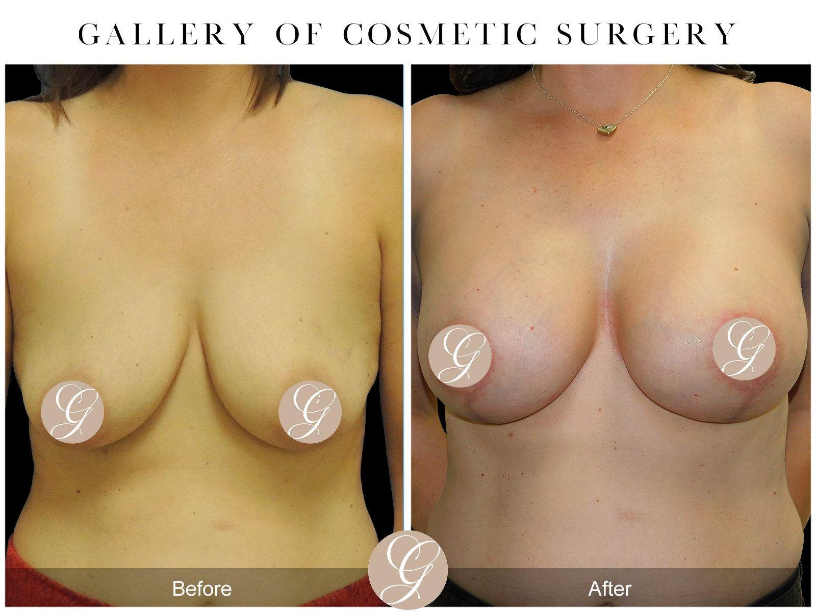 Breast Augmentation Lift with Mesh Image
