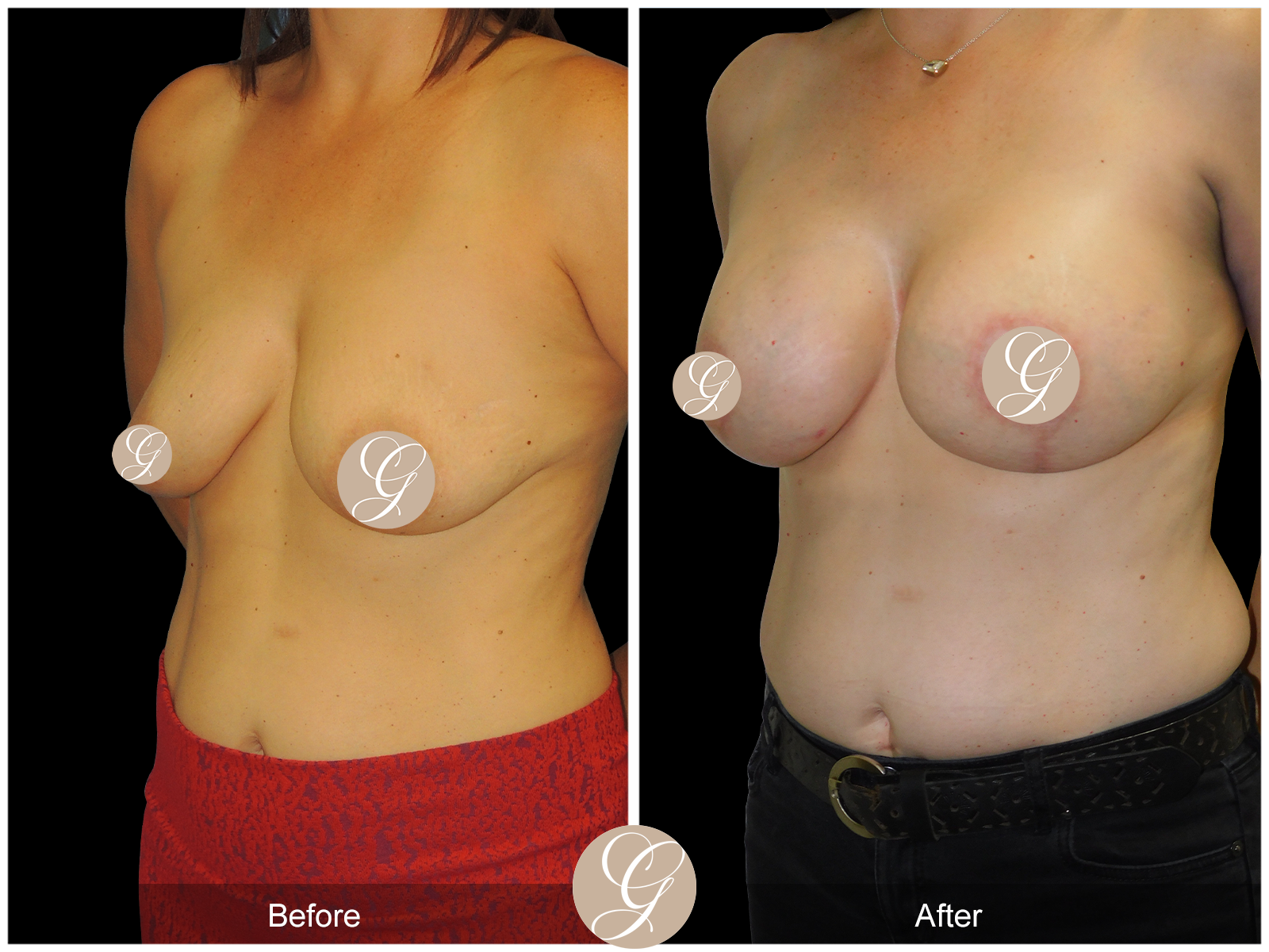 Breast Augmentation Lift with Mesh Image