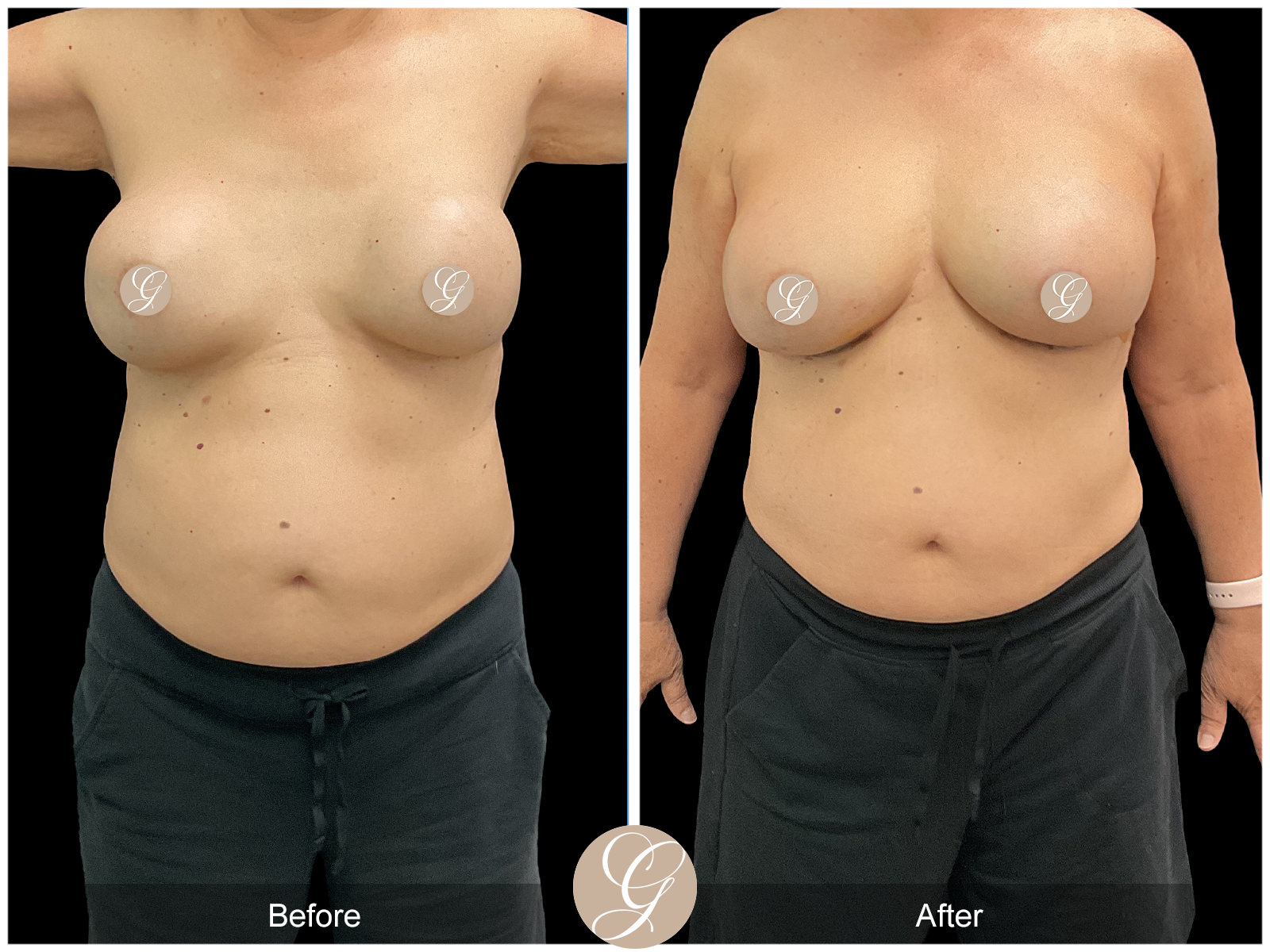 Breast Implant Revision 1 Image