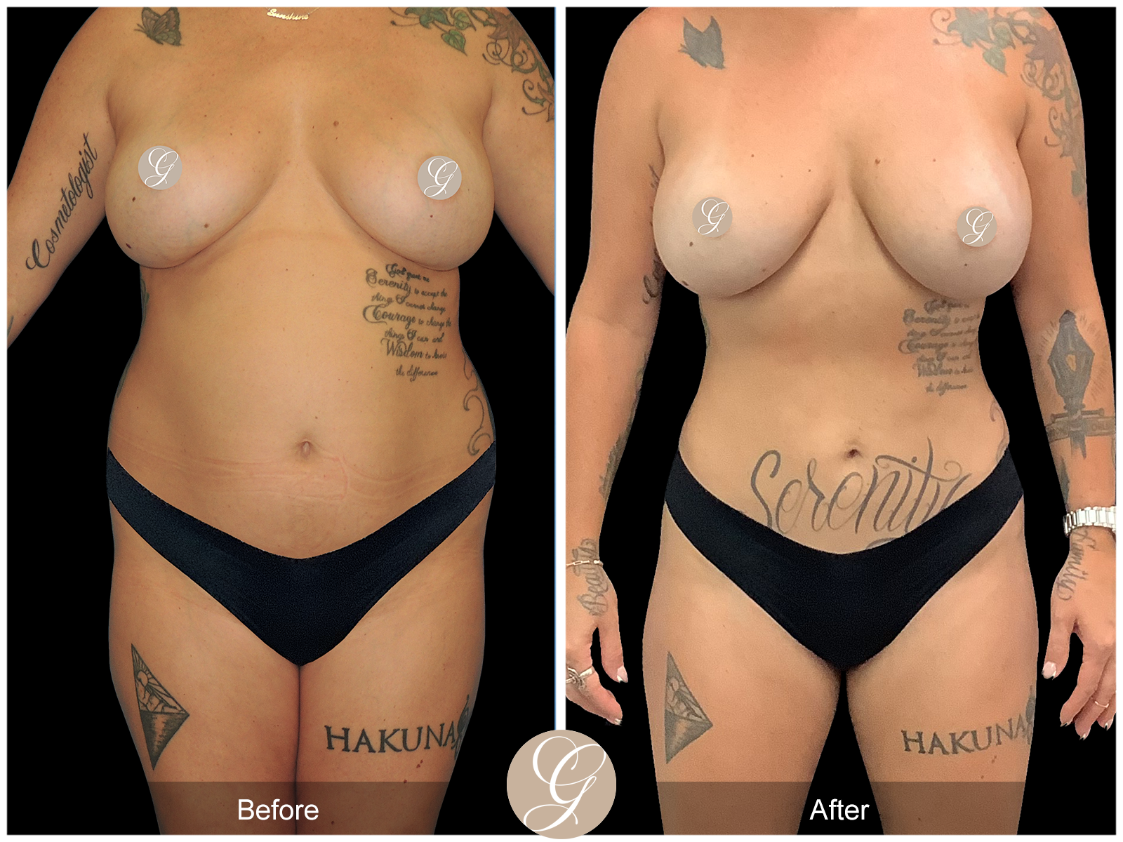 VASER 360 HIGH DEFINITION BODY SCULPTING PT14 Image