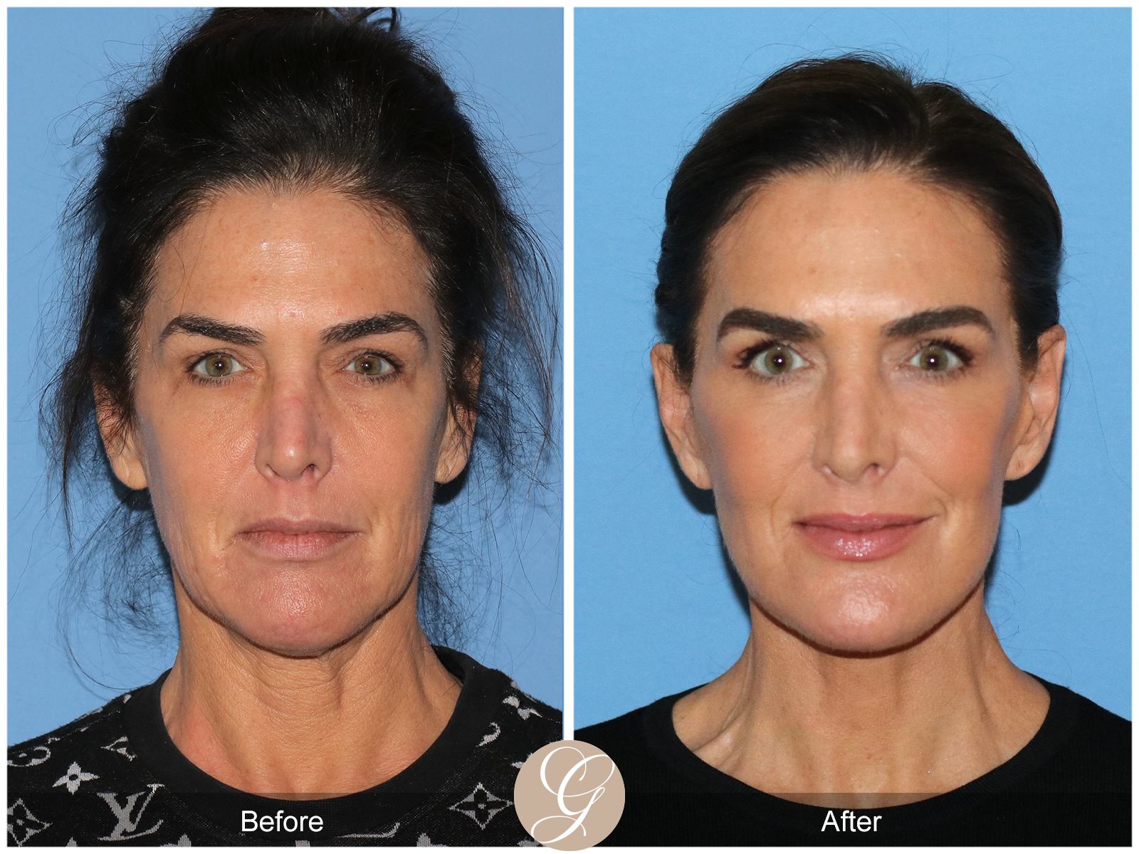 Preservation Facelift Case 1 Image