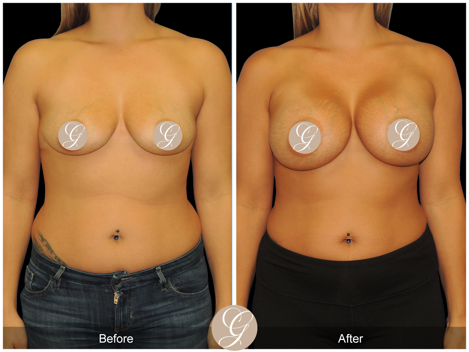 Breast Augmentation PT19 Image