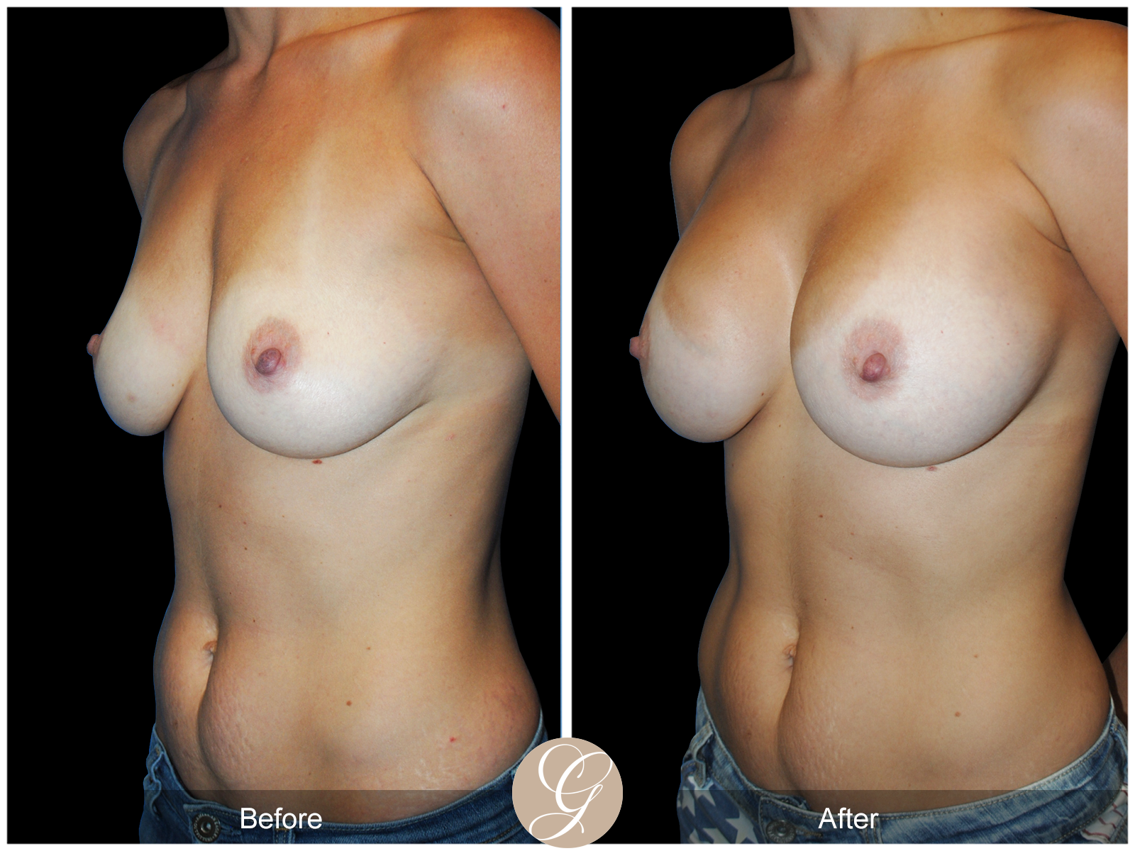 Breast Augmentation PT 21 Image