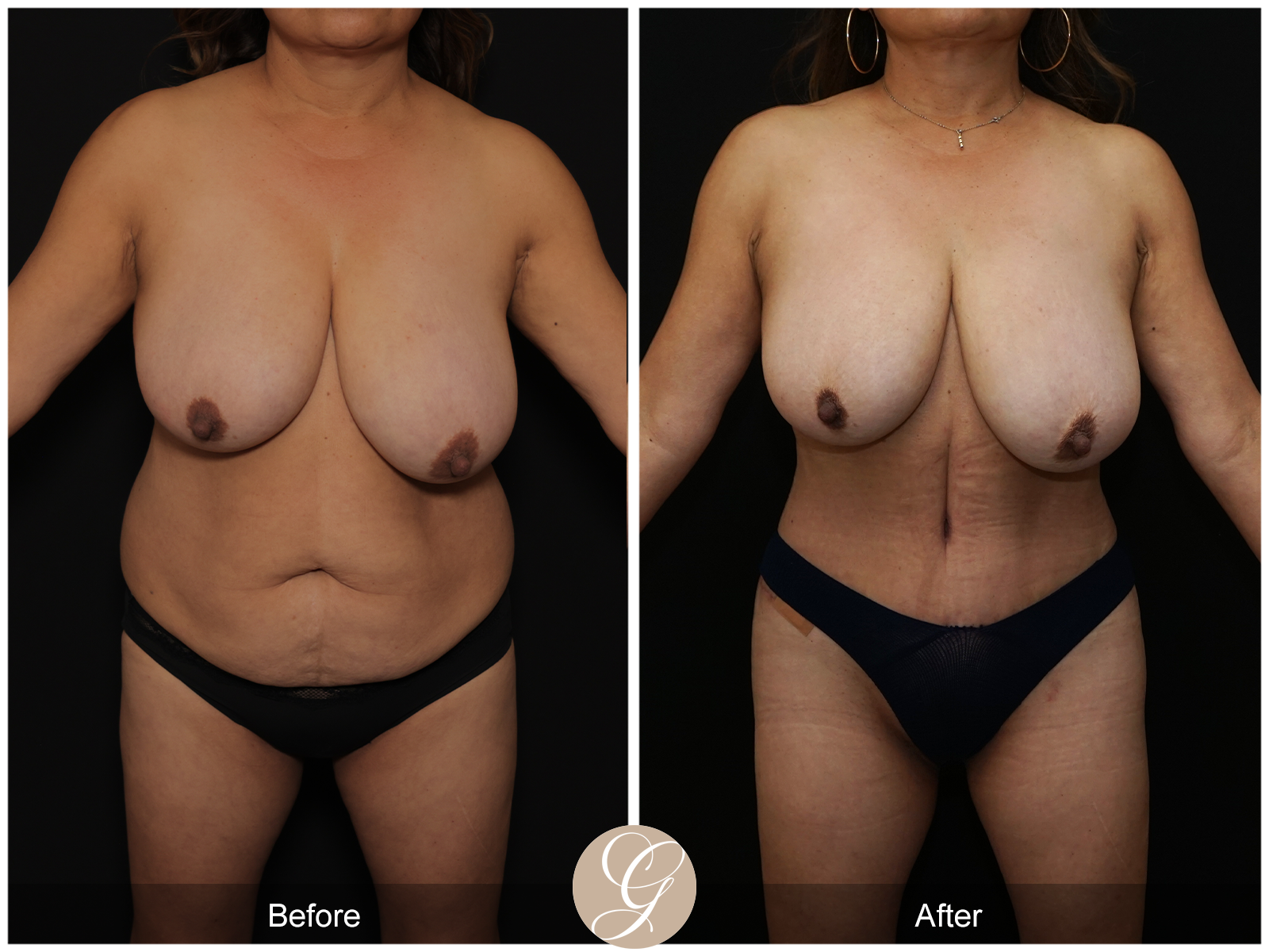 Tummy Tuck Pt 4 Image
