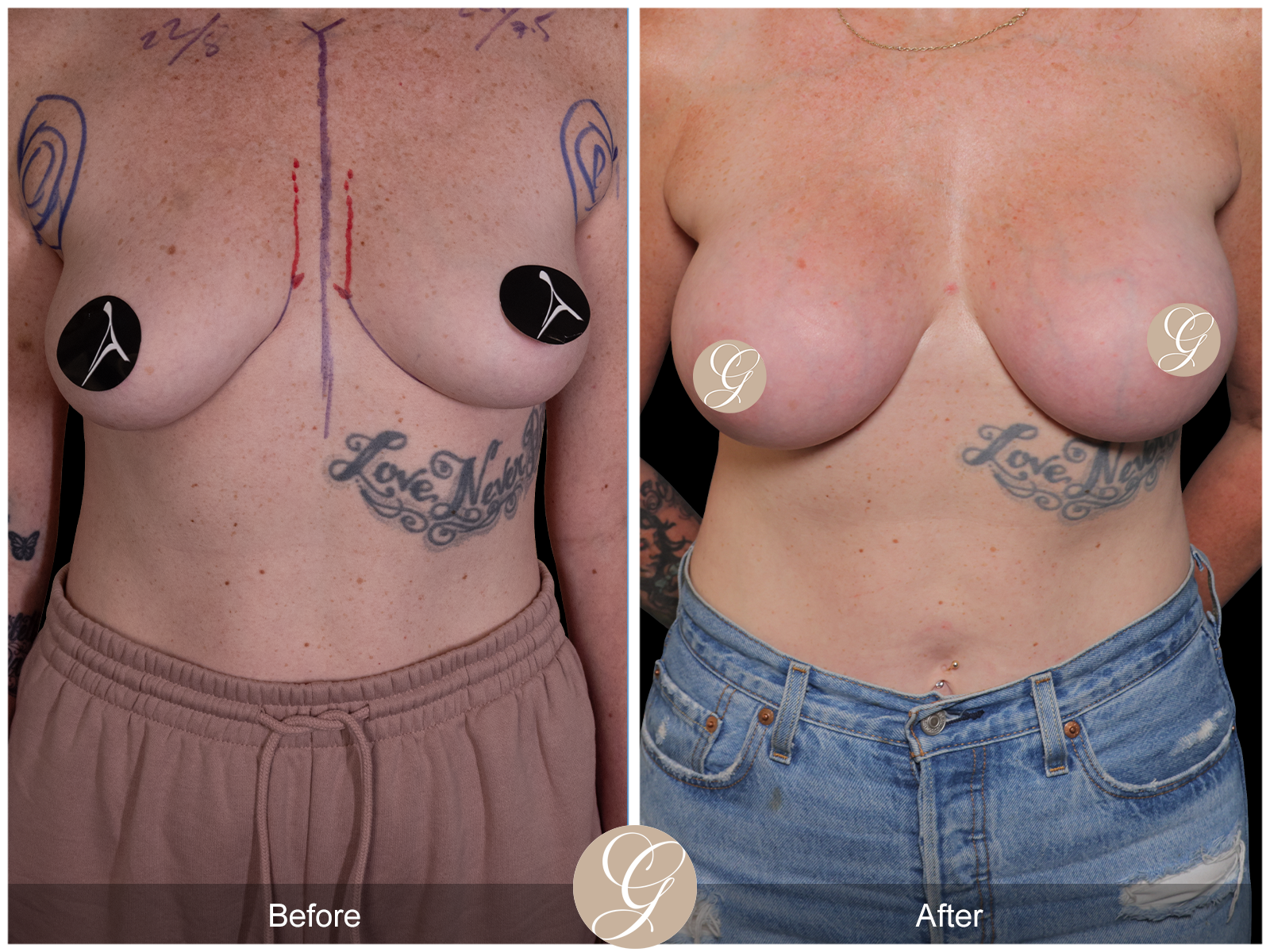 Breast Augmentation Image