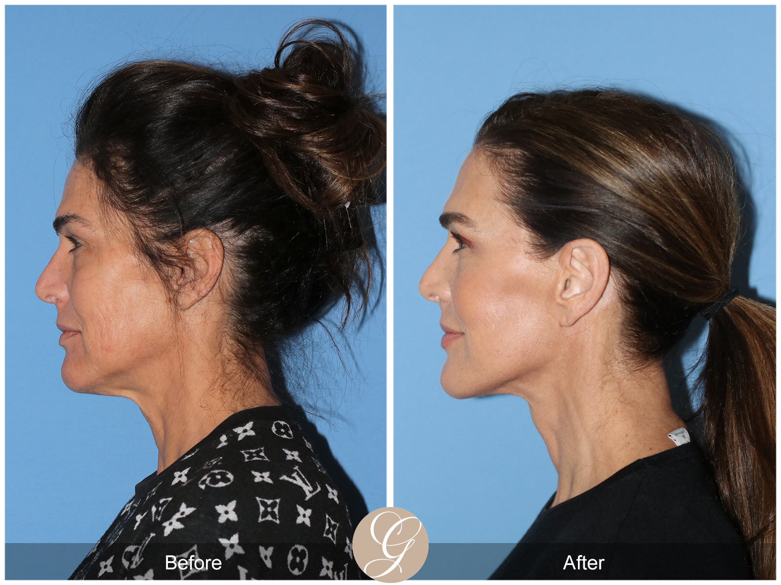 Preservation Facelift Case 1 Image