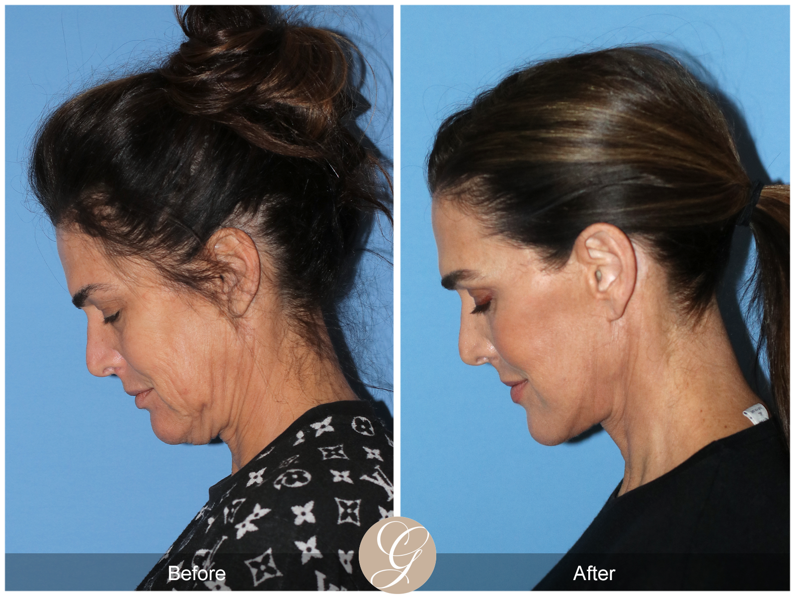 Preservation Facelift Case 1 Image