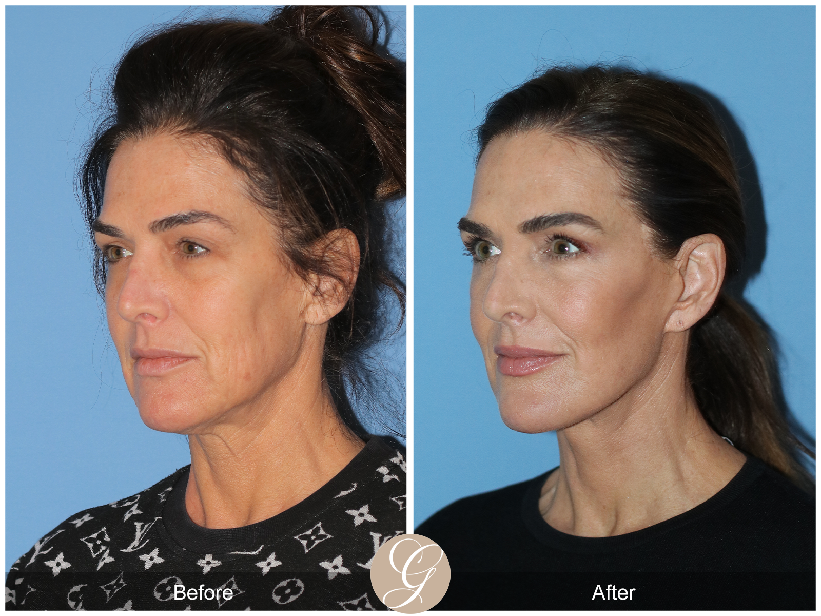 Preservation Facelift Case 1 Image