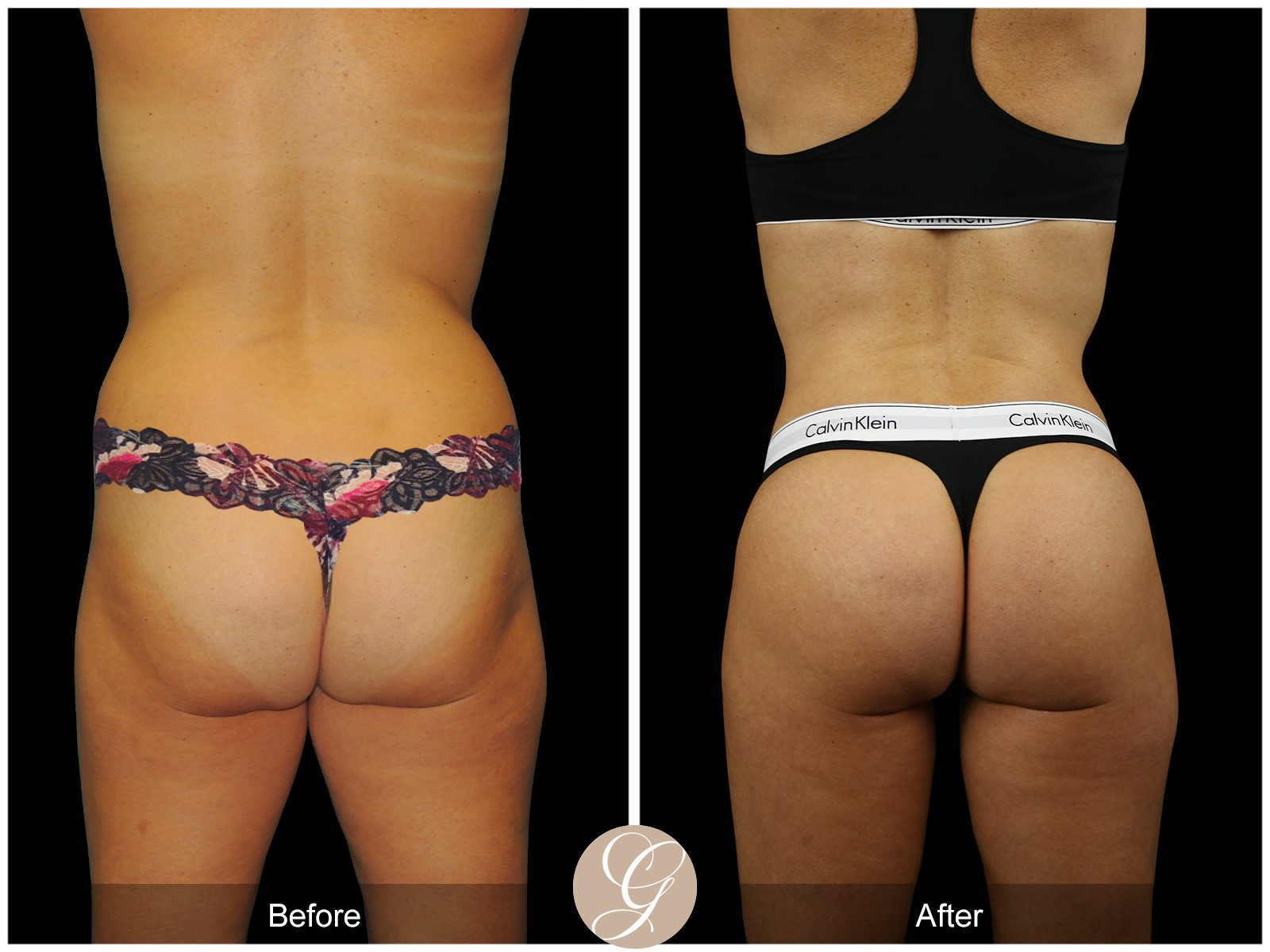 VASER 360 HIGH DEFINITION BODY SCULPTING PT13 Image