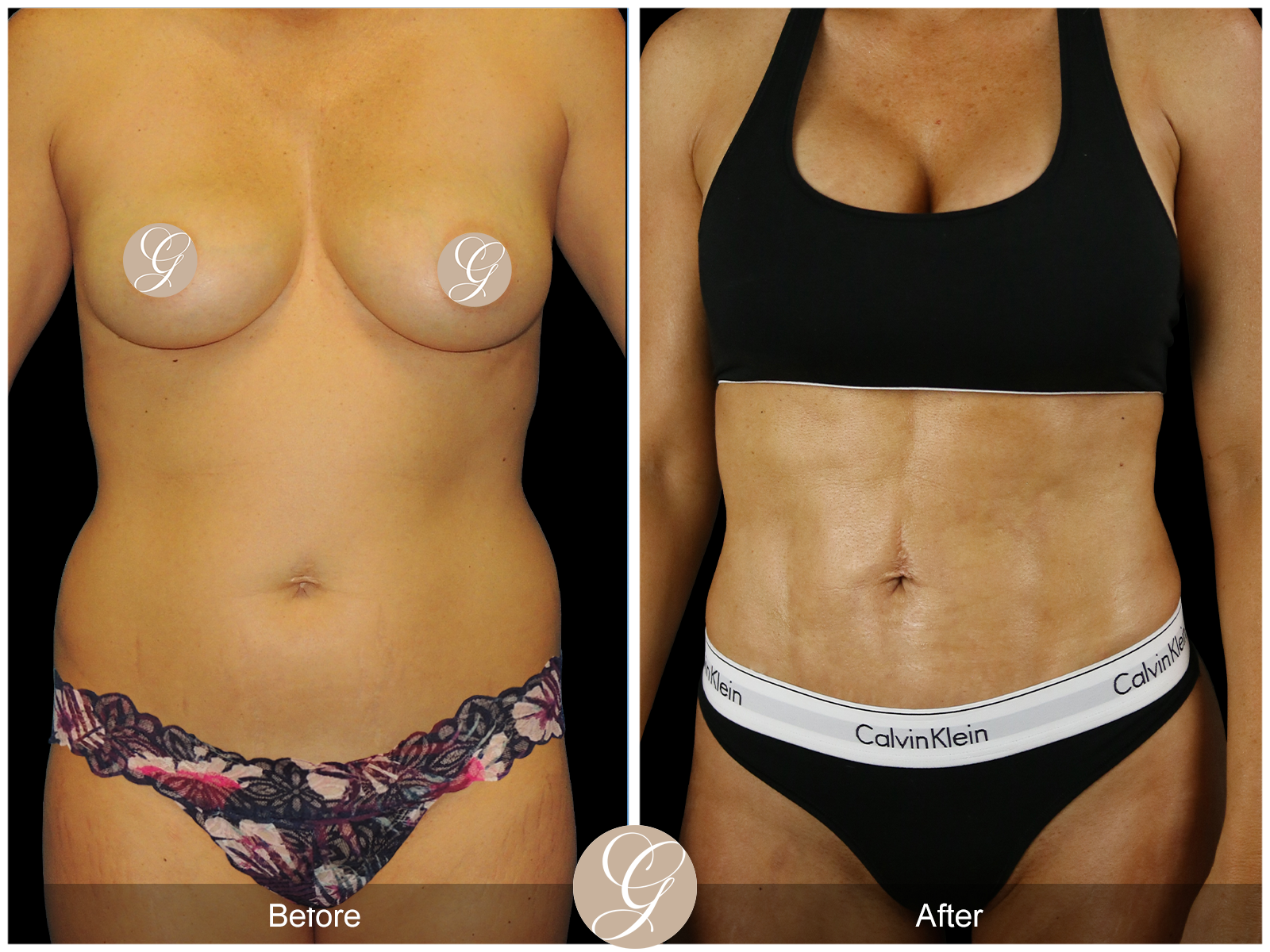 Best High Definition Body Contouring
