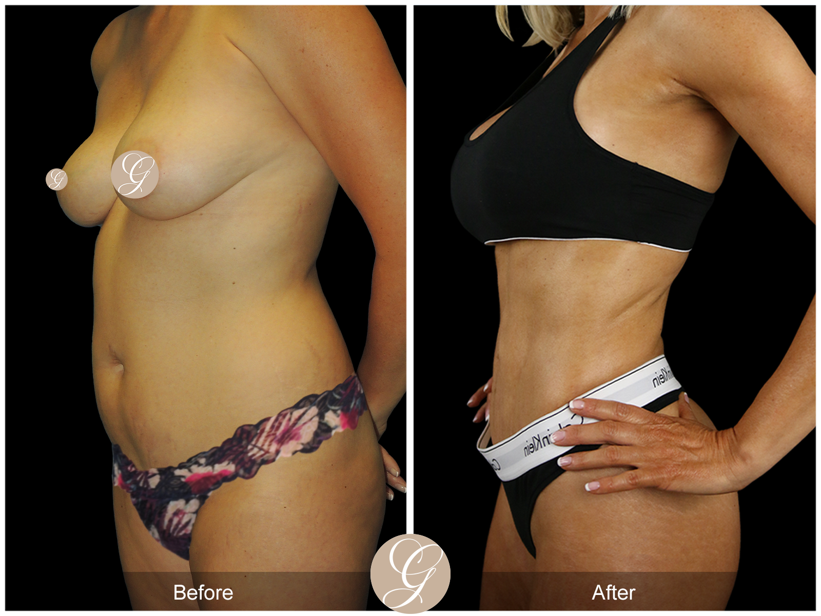 VASER 360 HIGH DEFINITION BODY SCULPTING PT13 Image