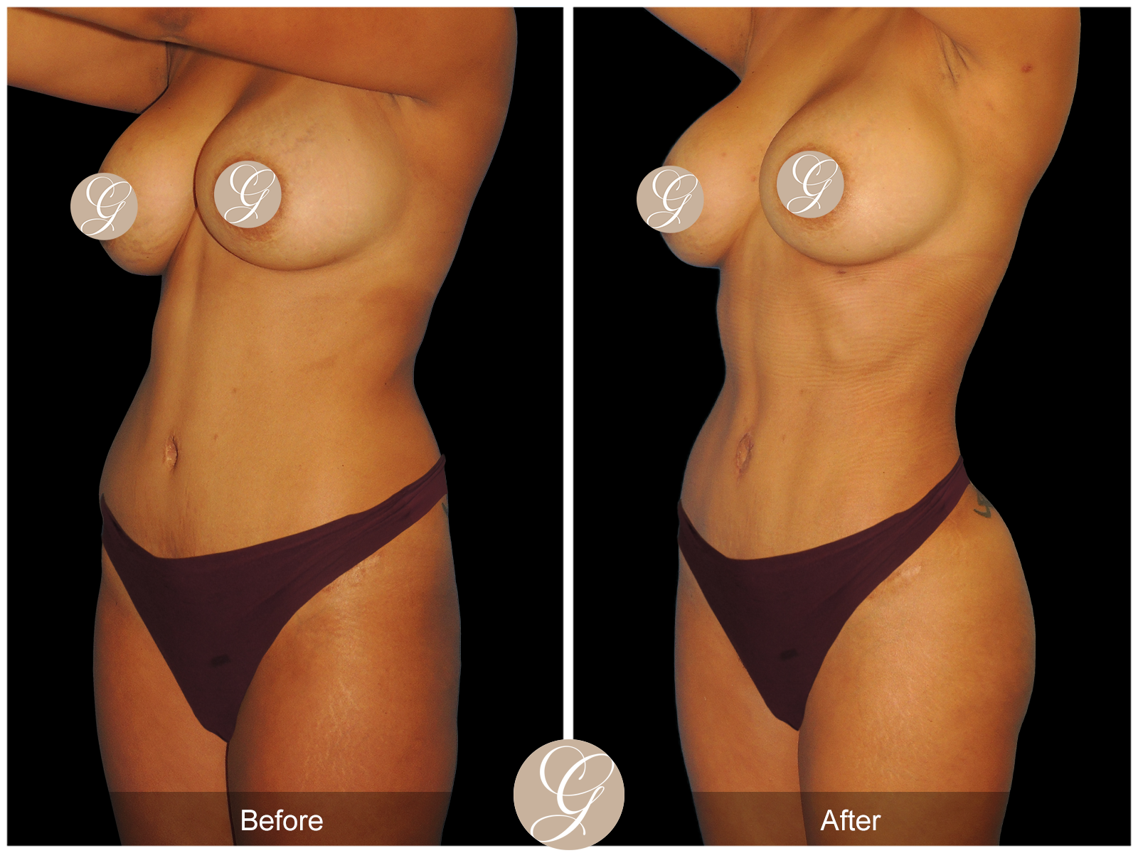 Mommy Makeover PT5 Image