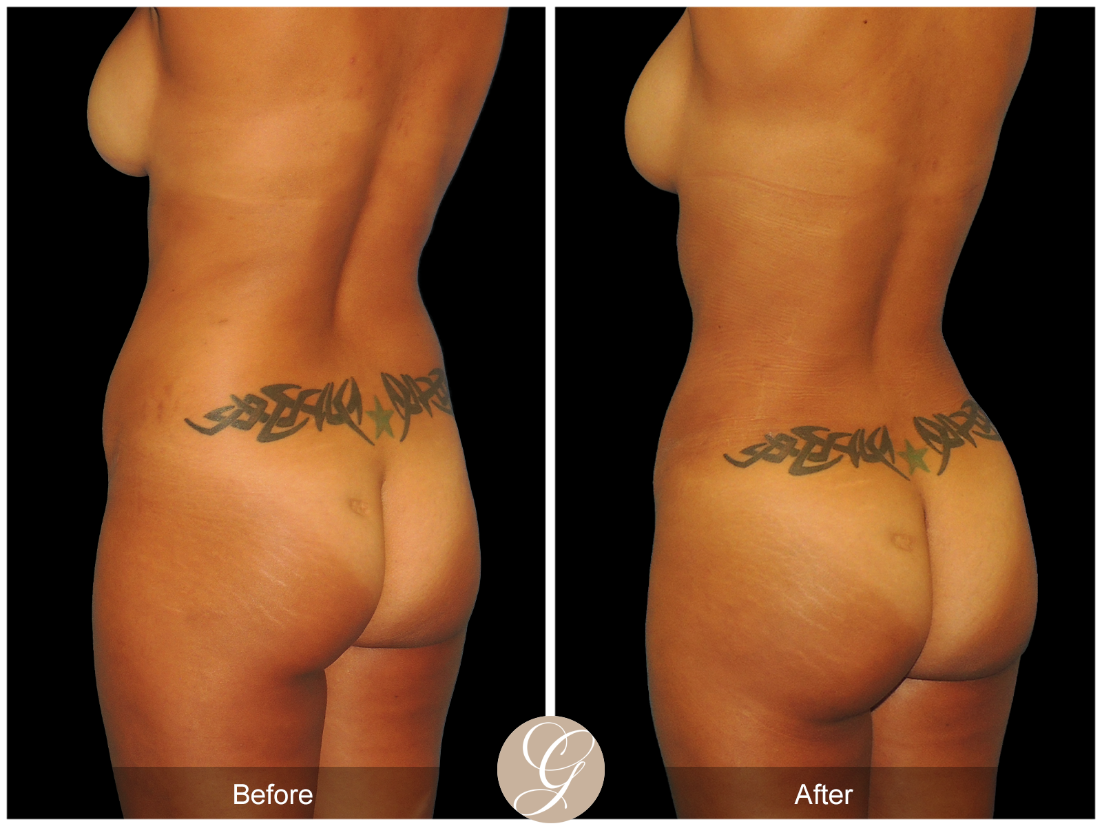 Mommy Makeover PT5 Image